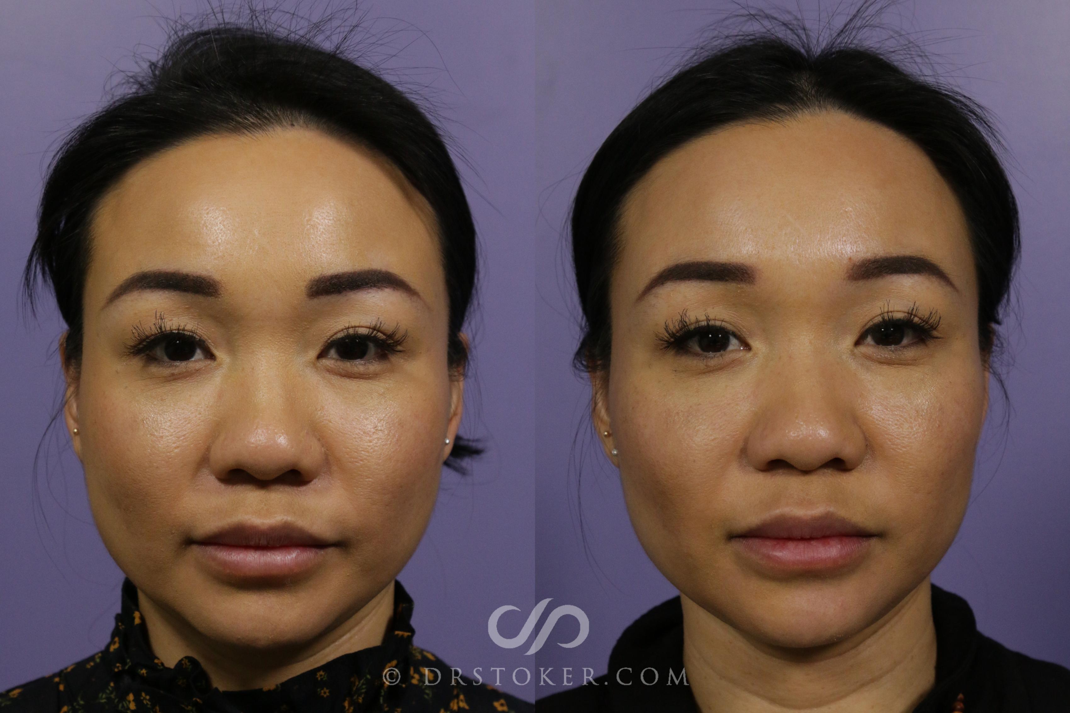 Before & After Cheek Fillers Case 1885 Front View in Los Angeles, CA