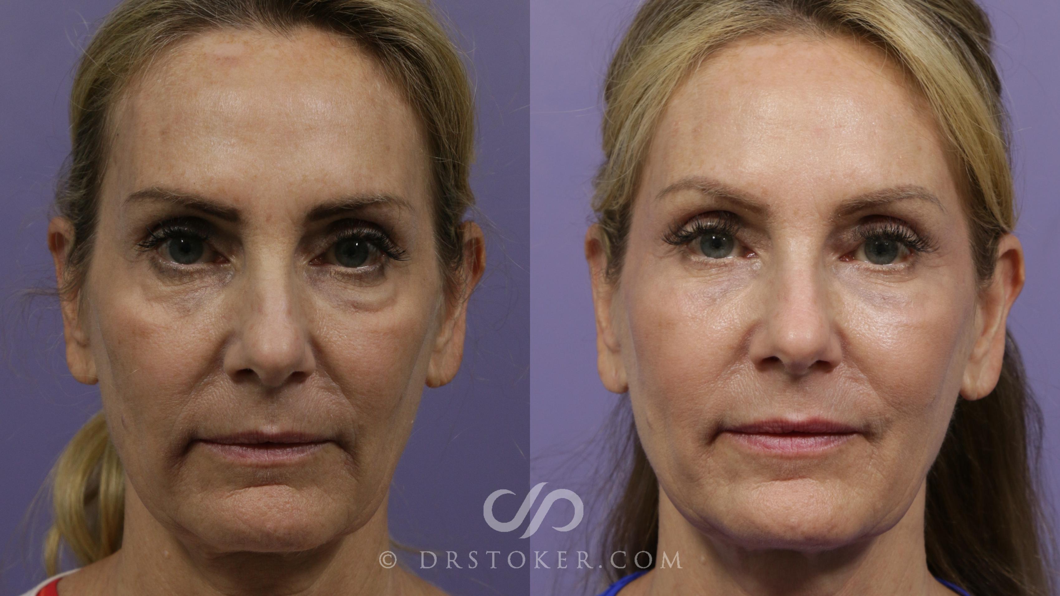 Before & After Cheek Fillers Case 2280 Front View in Los Angeles, CA