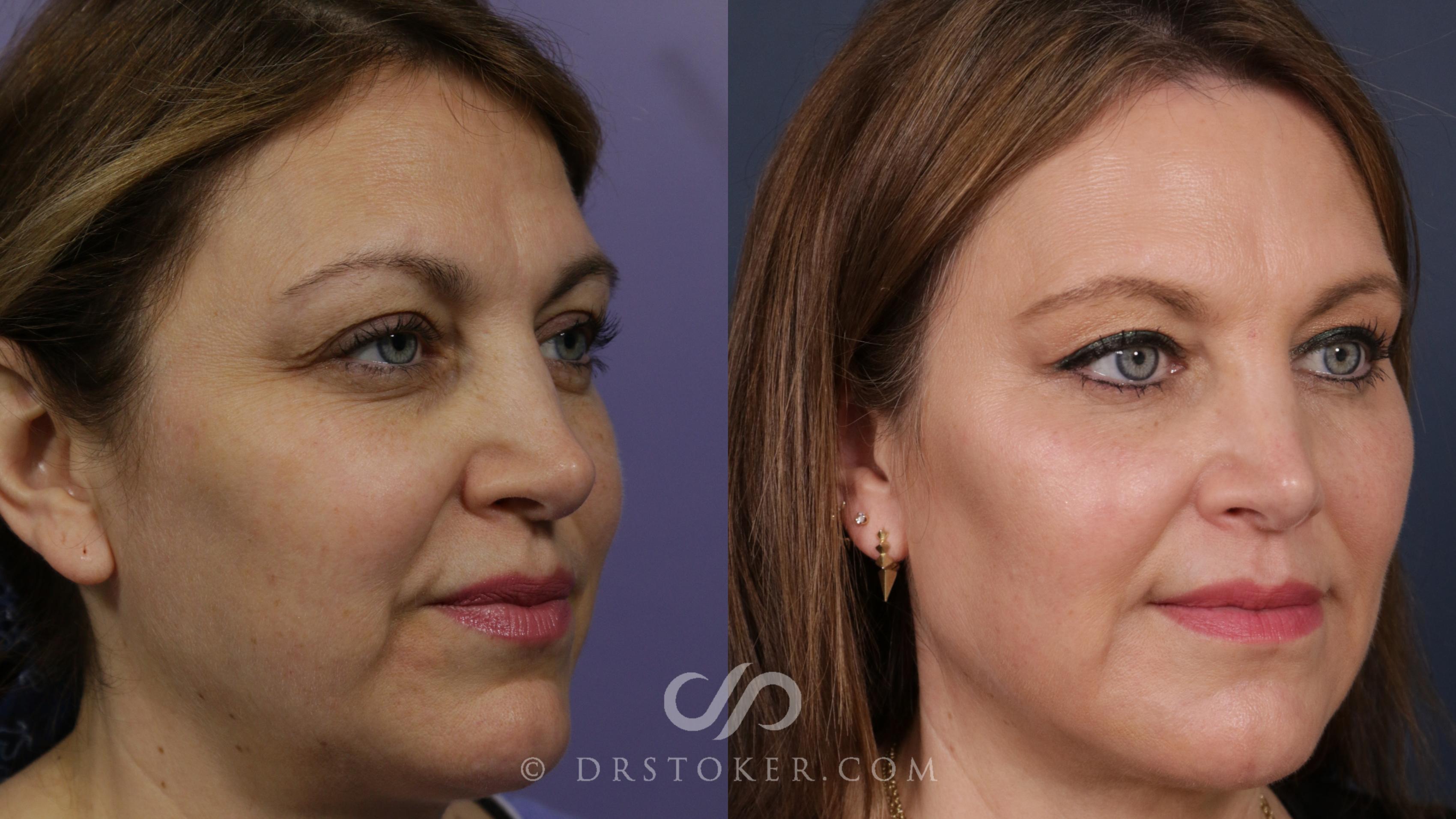 Before & After Cheek Fillers Case 2286 Right Side View in Los Angeles, CA