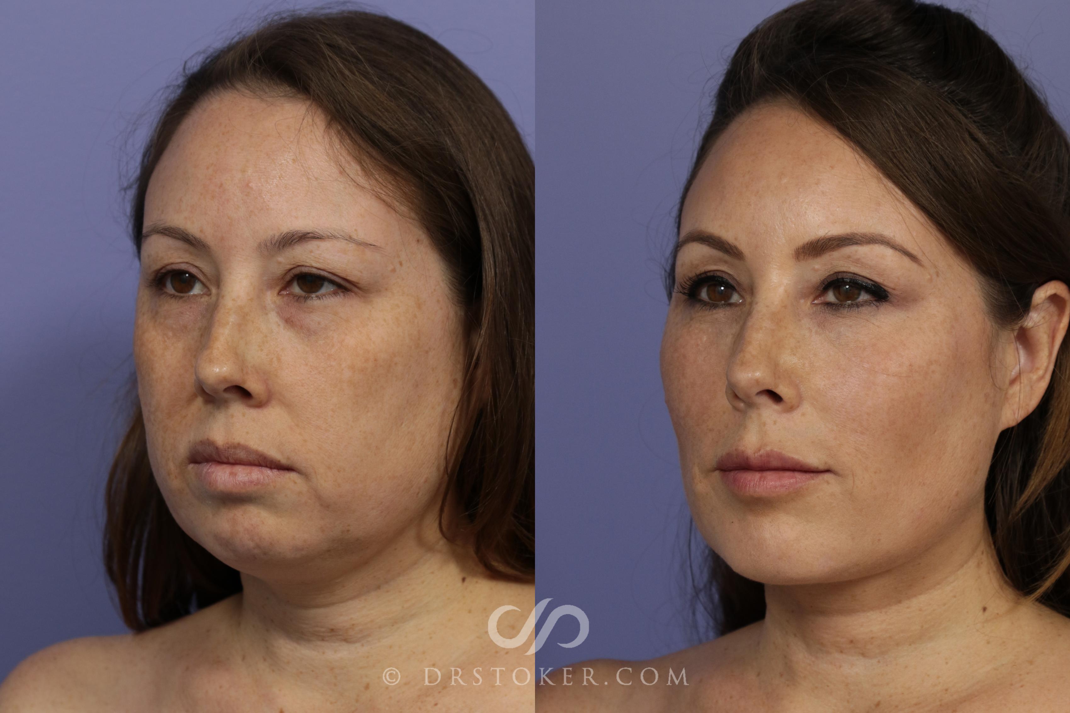 Before & After Cheek Fillers Case 886 View #1 View in Marina del Rey, CA