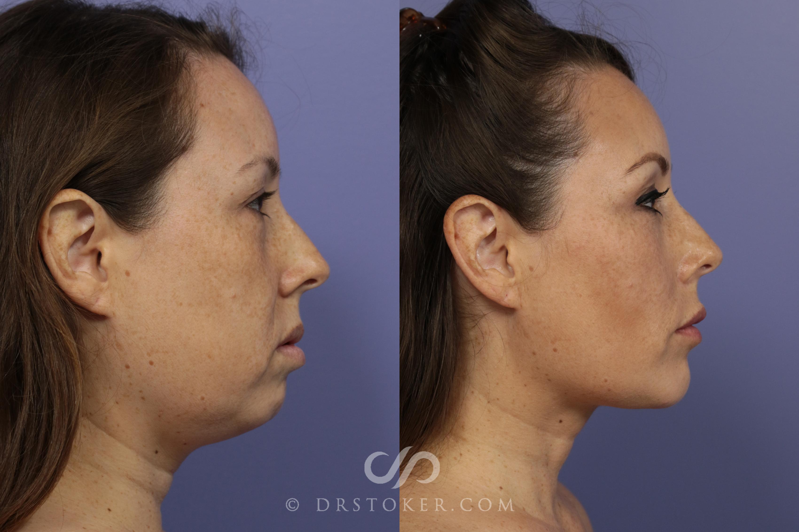 Before & After Cheek Fillers Case 886 View #2 View in Los Angeles, CA