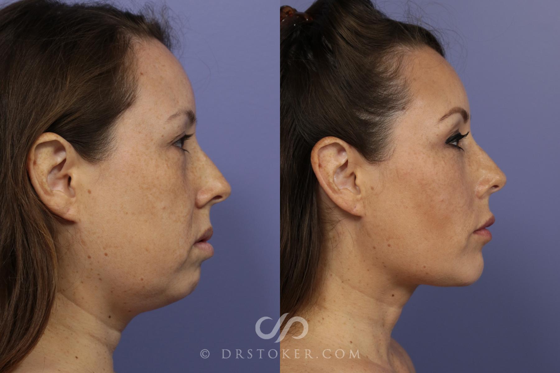 Before & After Buccal Fat Reduction Case 886 View #2 View in Los Angeles, CA