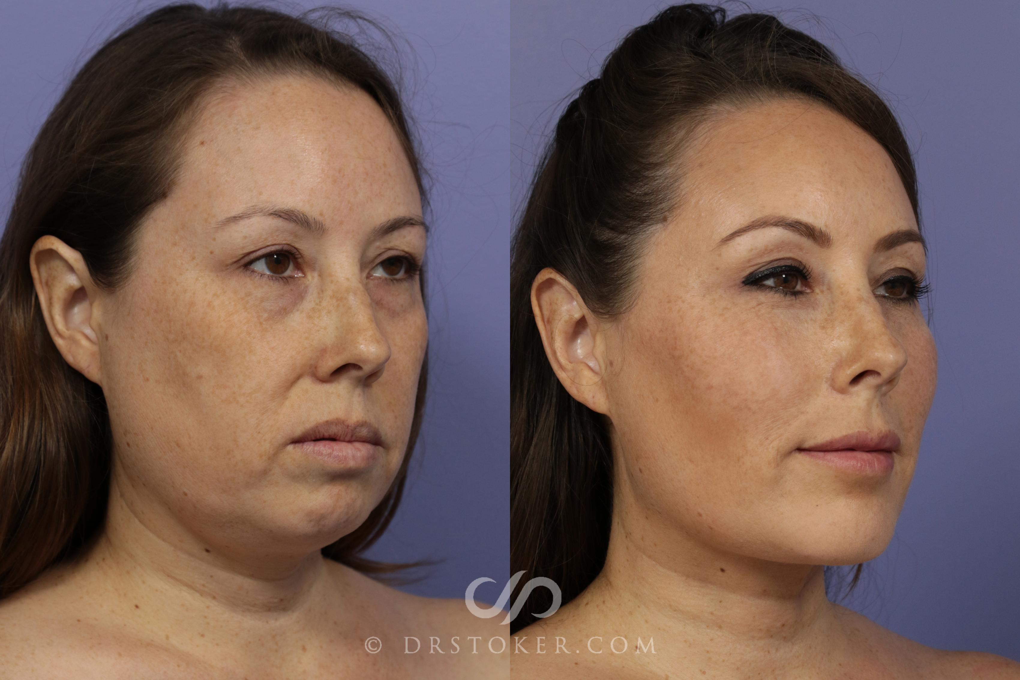 Before & After Cheek Fillers Case 886 View #3 View in Los Angeles, CA