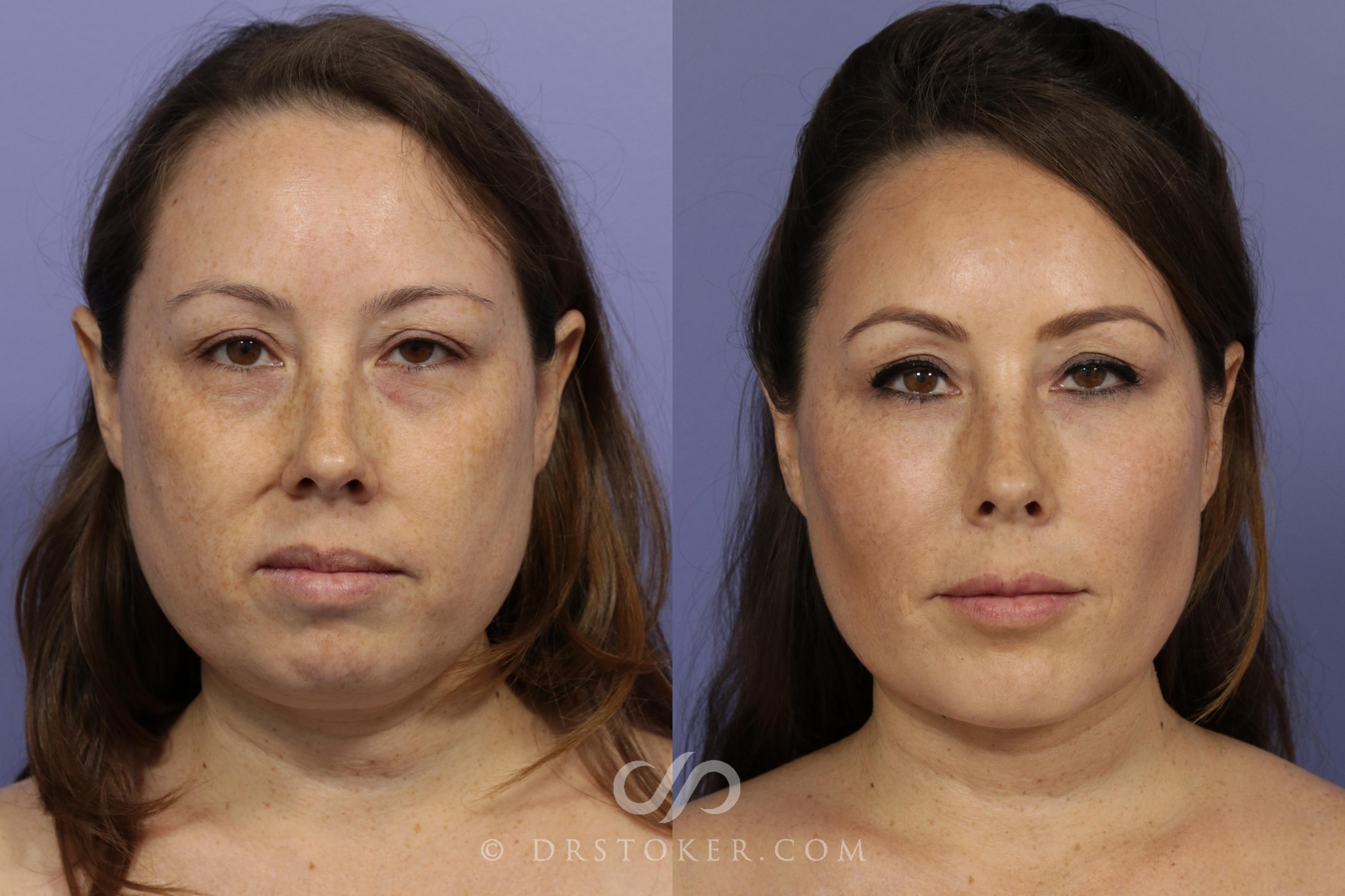 Before & After Cheek Fillers Case 886 View #4 View in Los Angeles, CA