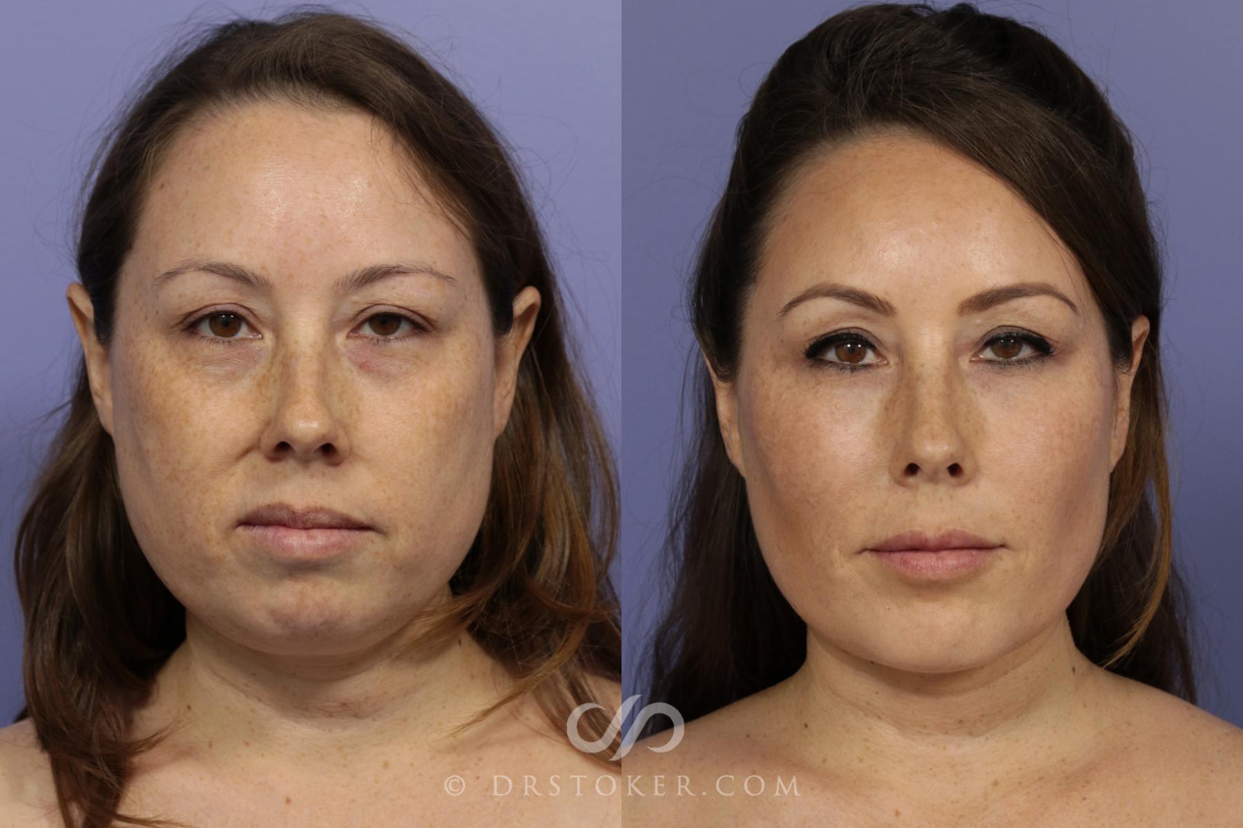 Before & After Undereye Fillers Case 886 View #4 View in Los Angeles, CA
