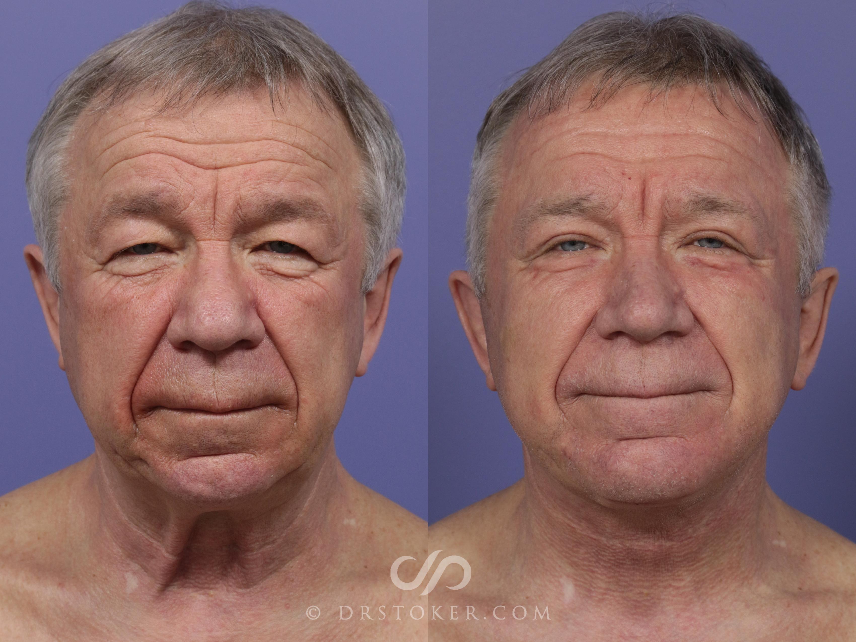 Before & After Cheek/Chin Contouring Case 1161 View #1 View in Los Angeles, CA