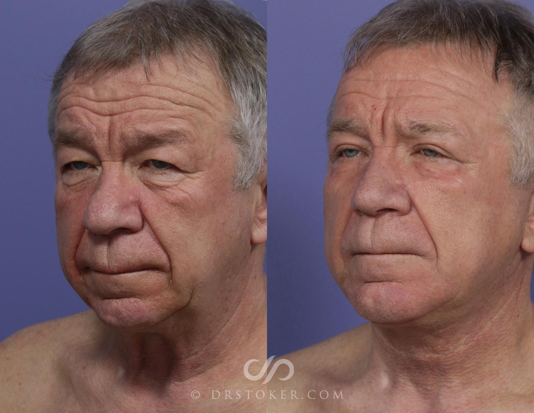 Before & After Cheek/Chin Contouring Case 1161 View #2 View in Los Angeles, CA