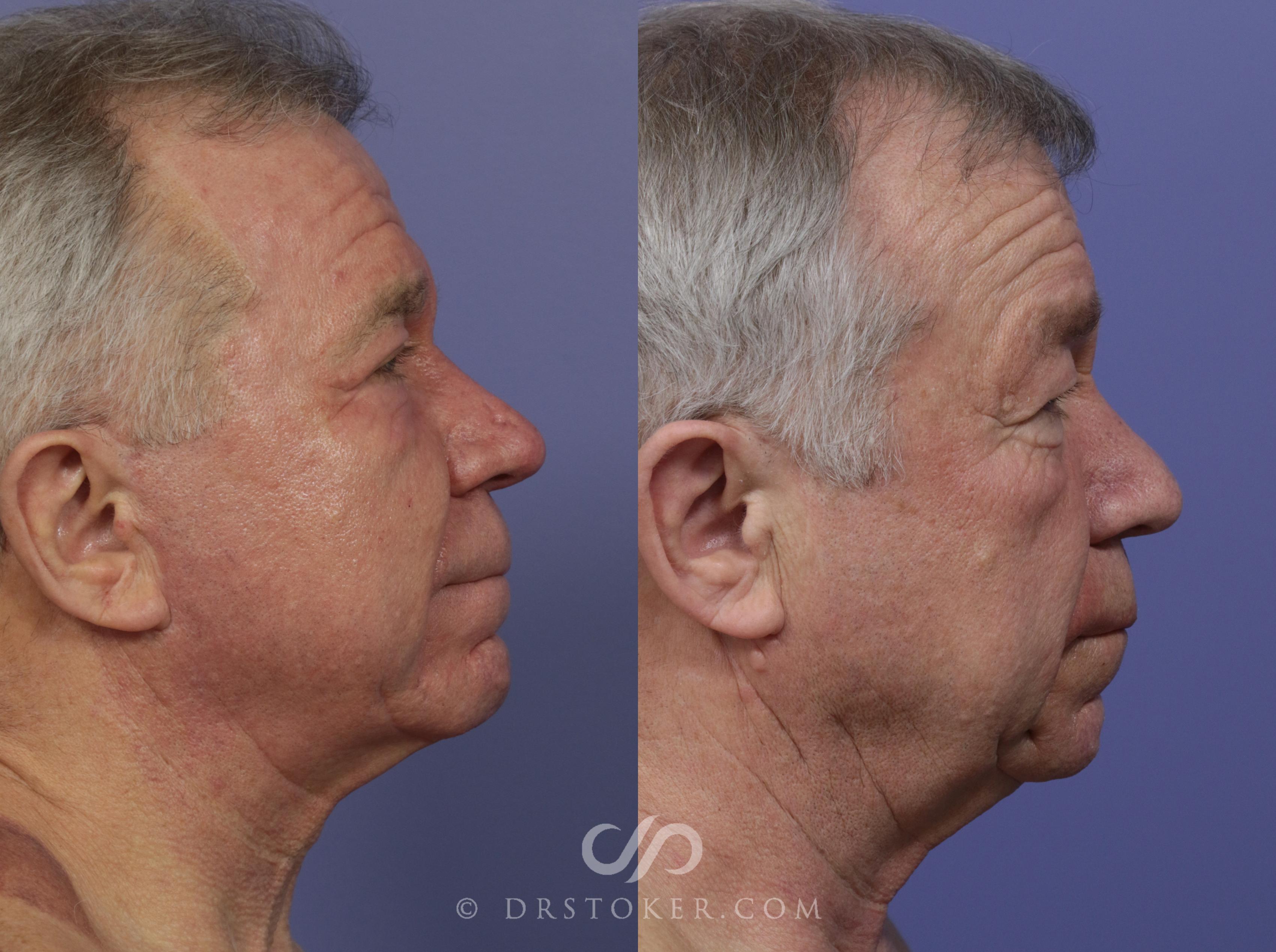 Before & After Cheek/Chin Contouring Case 1161 View #3 View in Los Angeles, CA