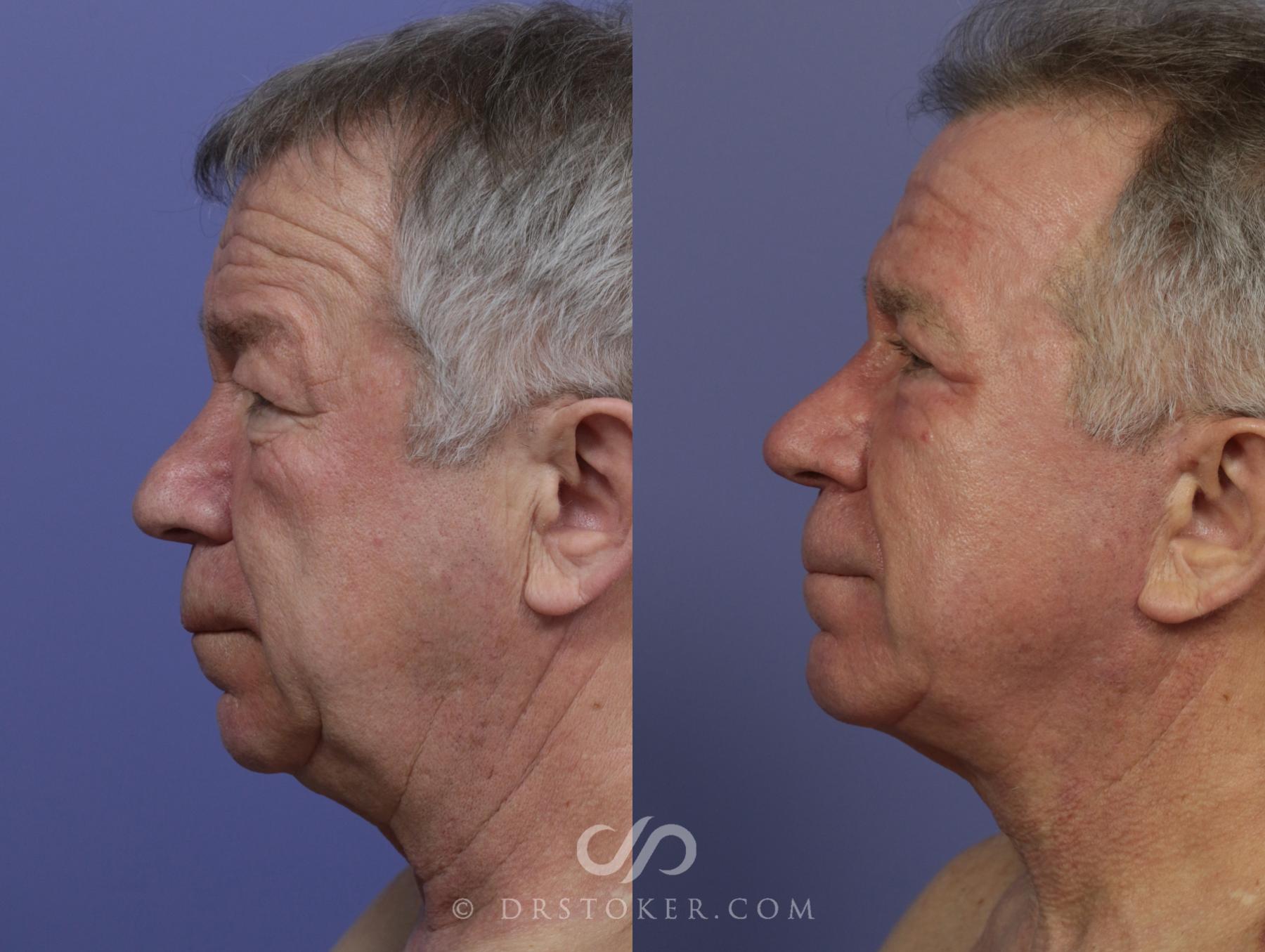 Before & After Cheek/Chin Contouring Case 1161 View #4 View in Los Angeles, CA