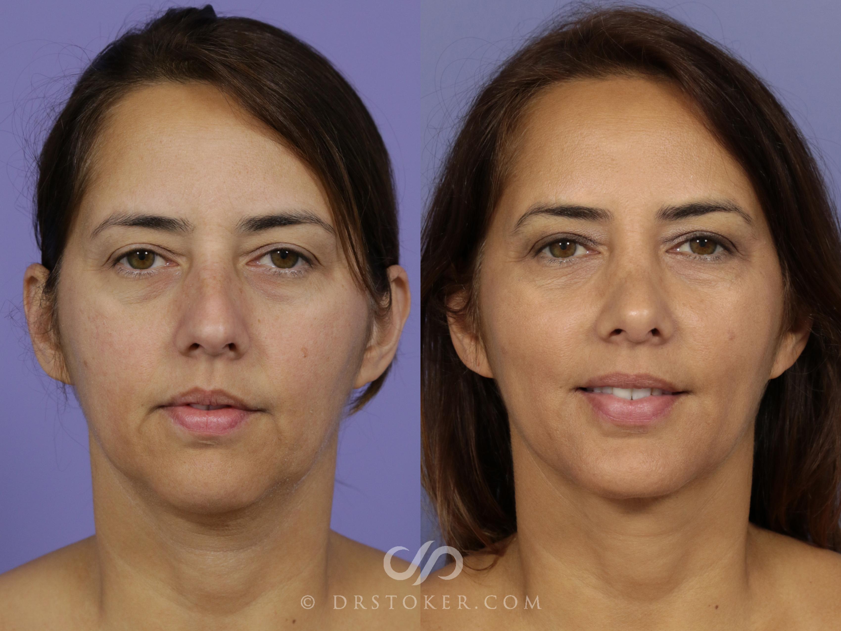 Before & After Cheek/Chin Contouring Case 1162 View #1 View in Los Angeles, CA