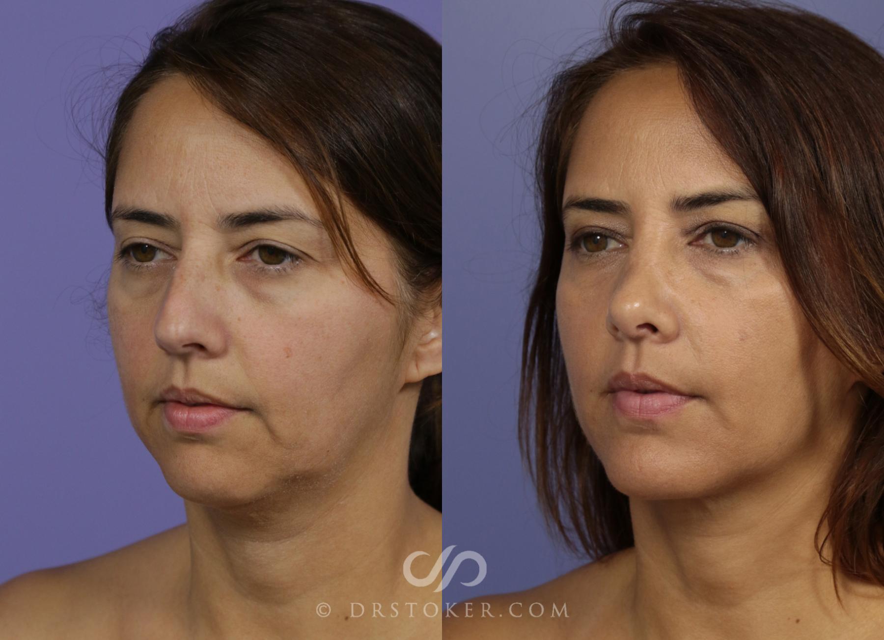 Before & After Cheek/Chin Contouring Case 1162 View #2 View in Los Angeles, CA