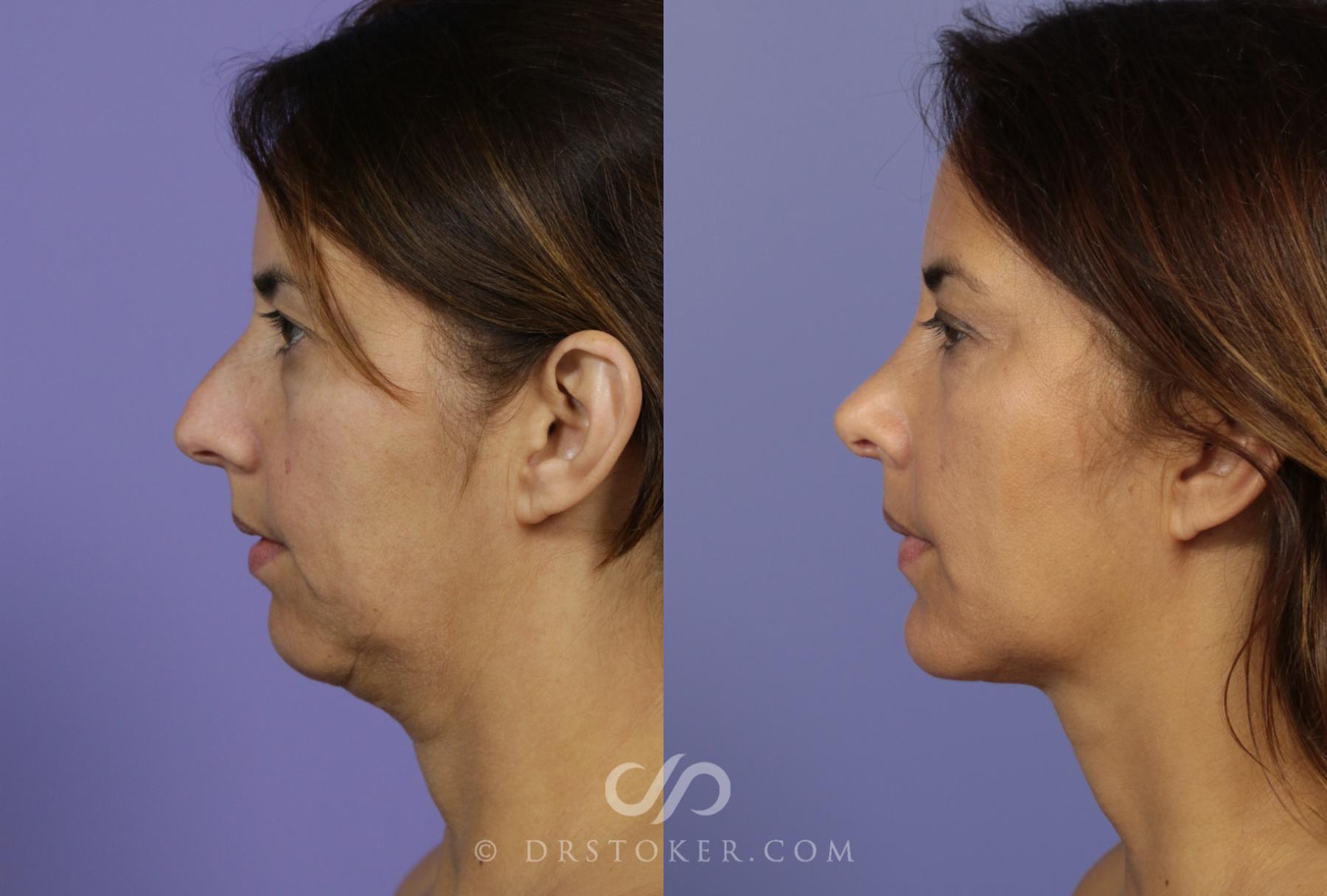 Before & After Cheek/Chin Contouring Case 1162 View #3 View in Los Angeles, CA