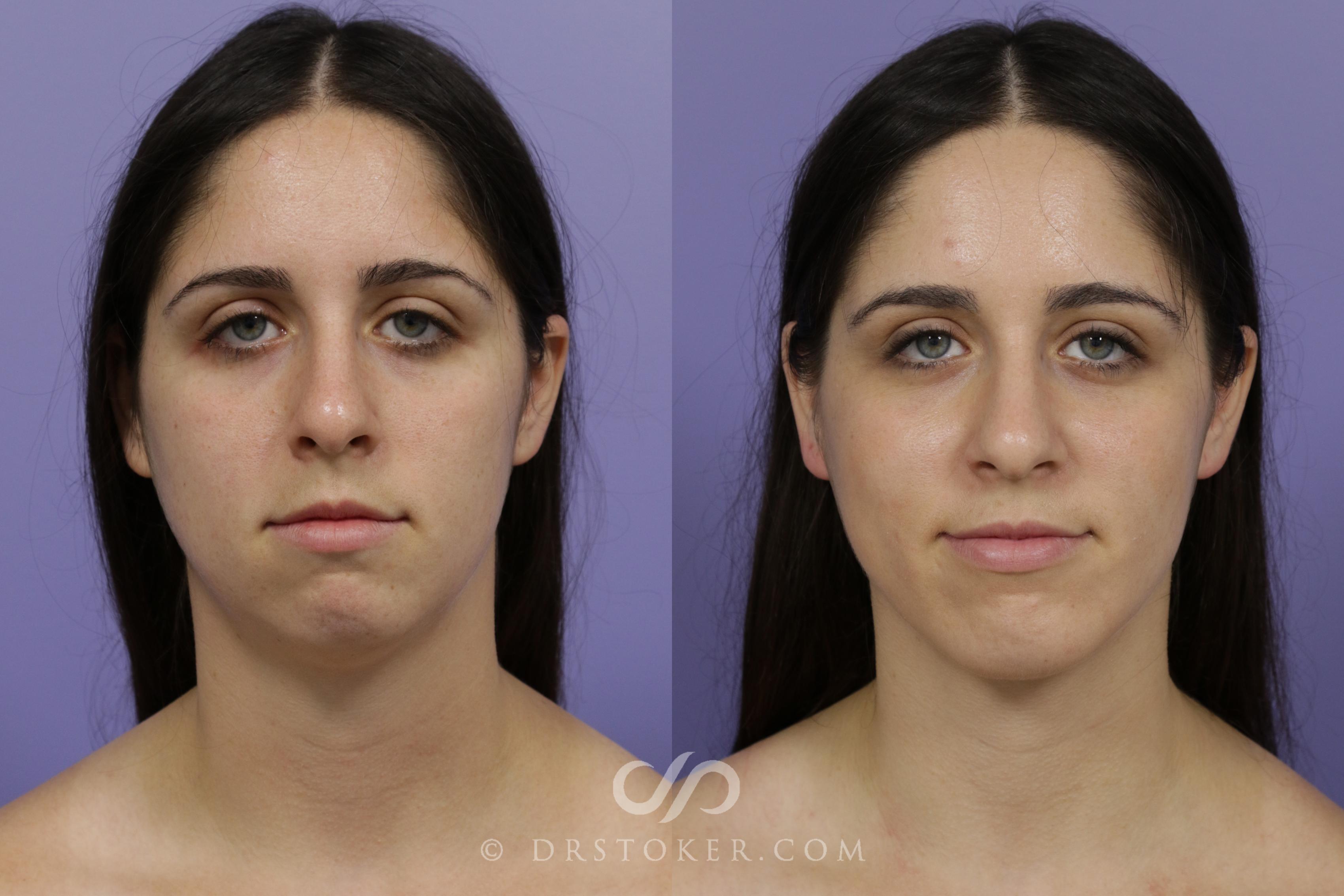 Before & After Cheek/Chin Contouring Case 1415 View #1 View in Los Angeles, CA