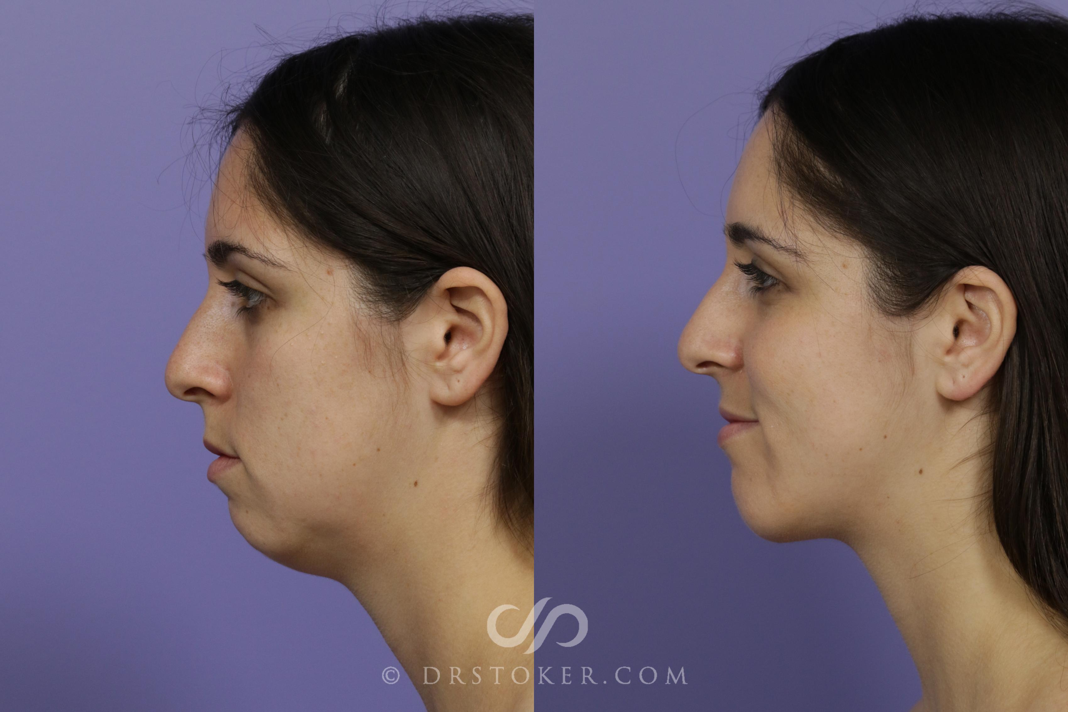 Before & After Cheek/Chin Contouring Case 1415 View #2 View in Los Angeles, CA