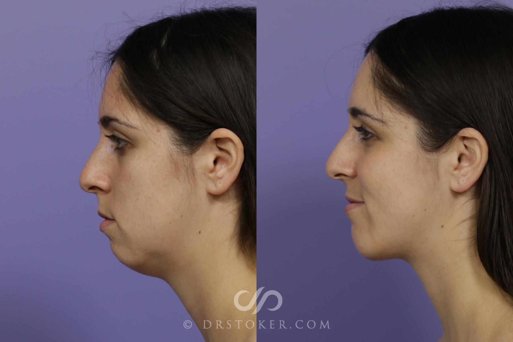 Before & After Cheek/Chin Contouring Case 1415 View #2 View in Los Angeles, CA