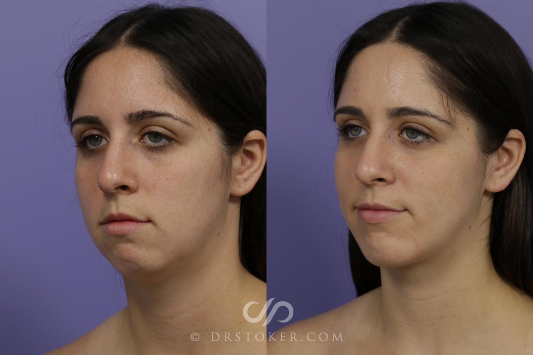 Before & After Cheek/Chin Contouring Case 1415 View #3 View in Los Angeles, CA