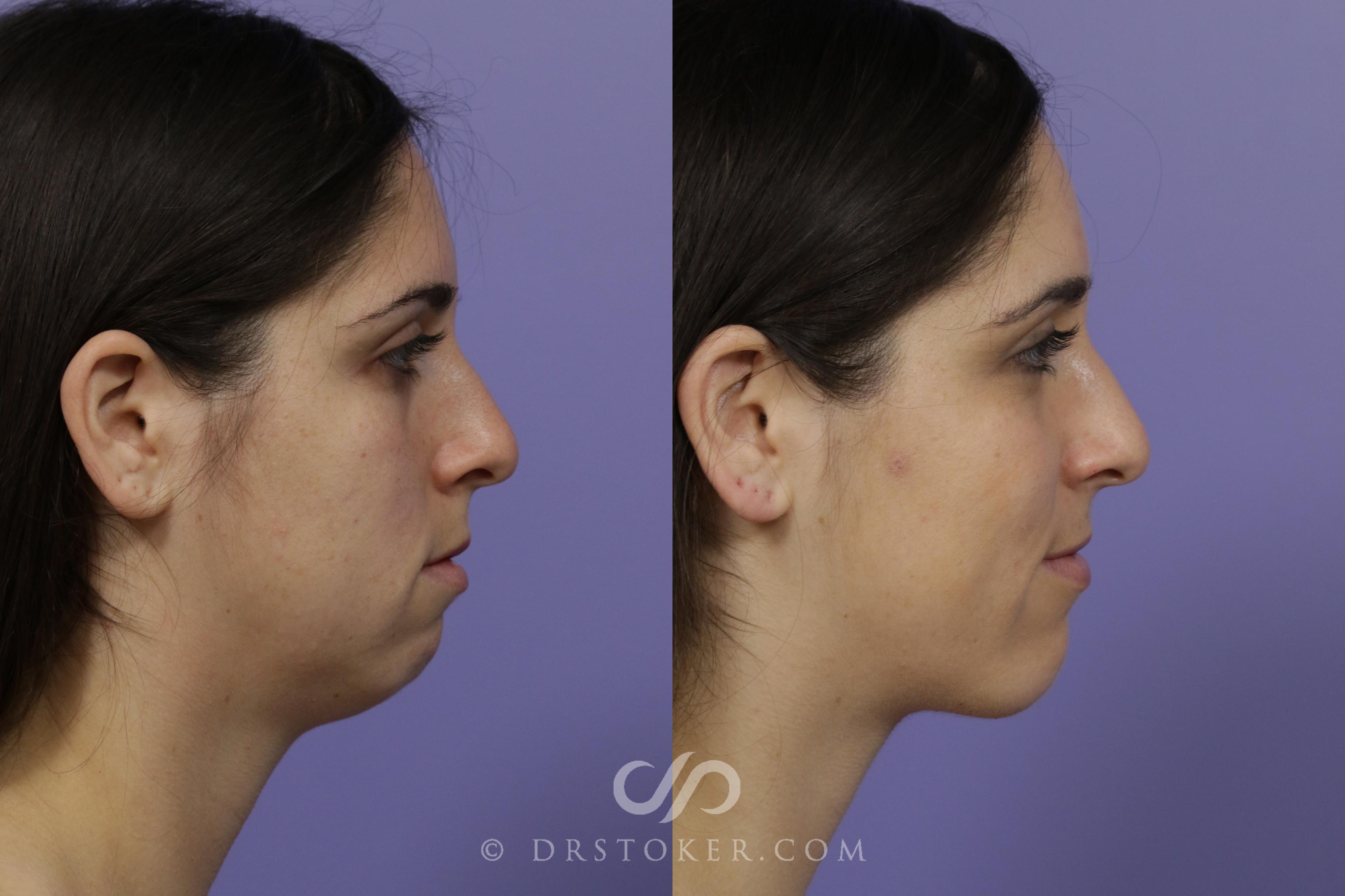 Before & After Cheek/Chin Contouring Case 1416 View #1 View in Los Angeles, CA