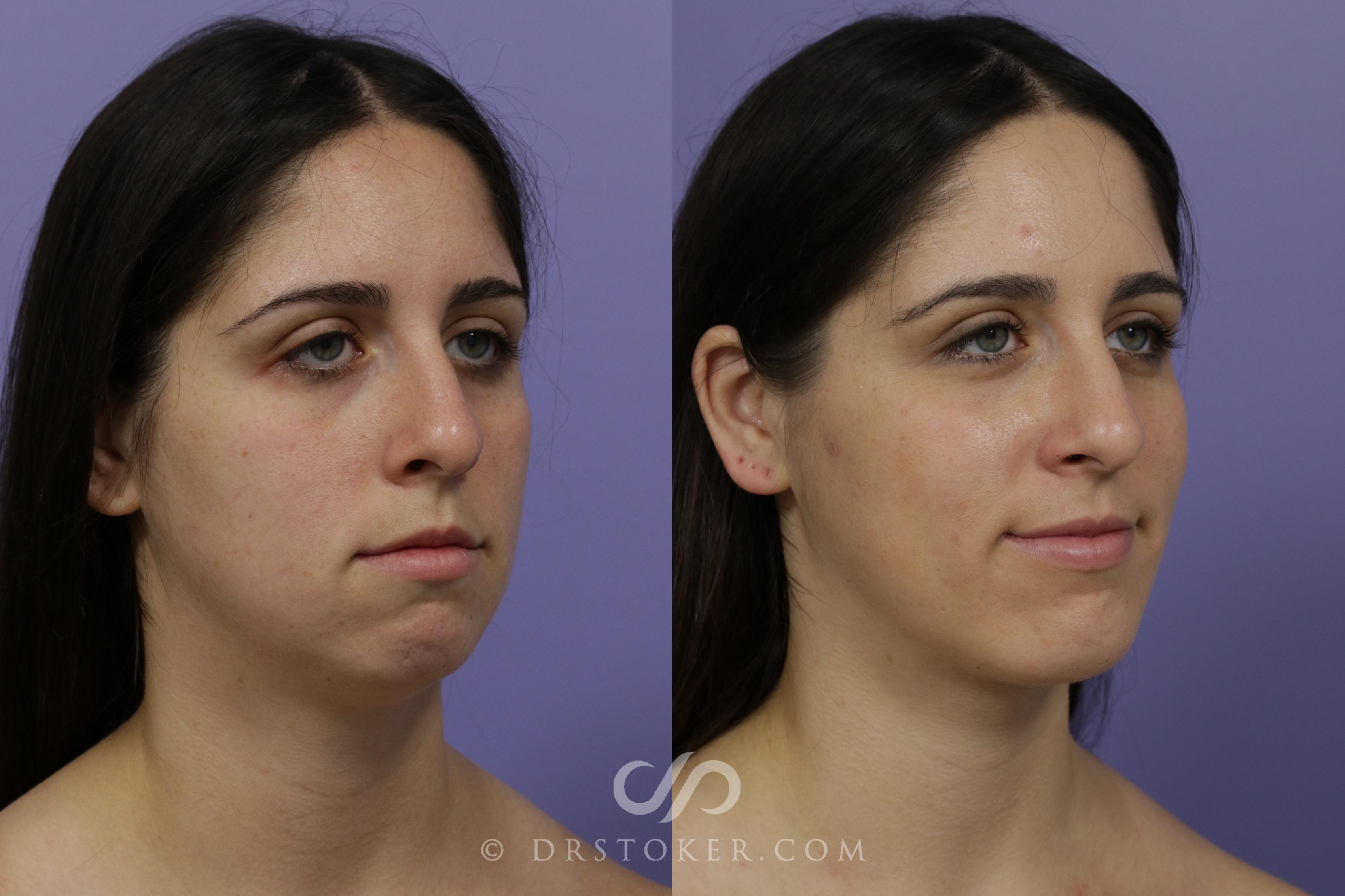 Before & After Cheek/Chin Contouring Case 1416 View #2 View in Los Angeles, CA