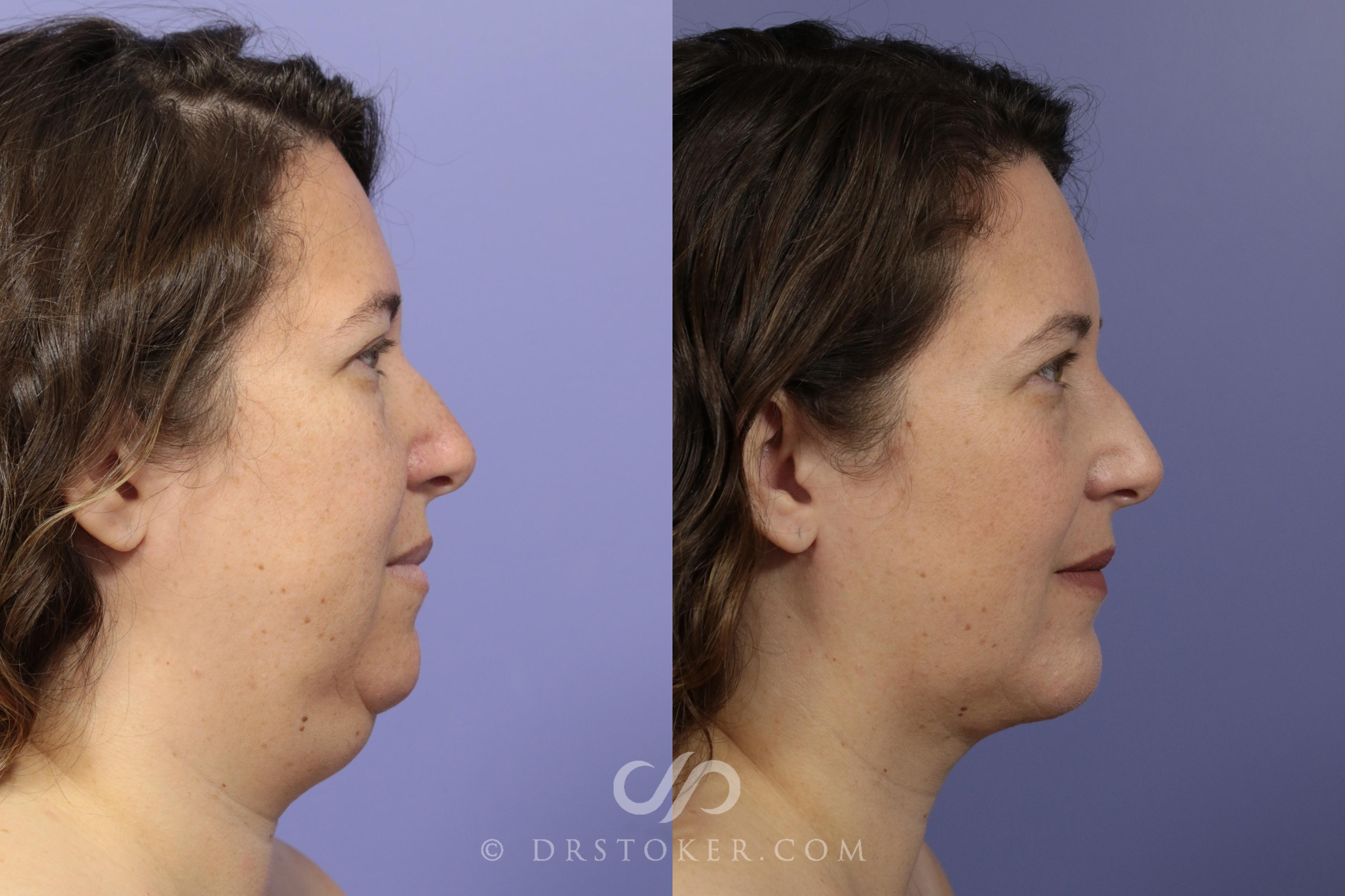 Before & After Chin Augmentation Case 1470 View #1 View in Marina del Rey, CA