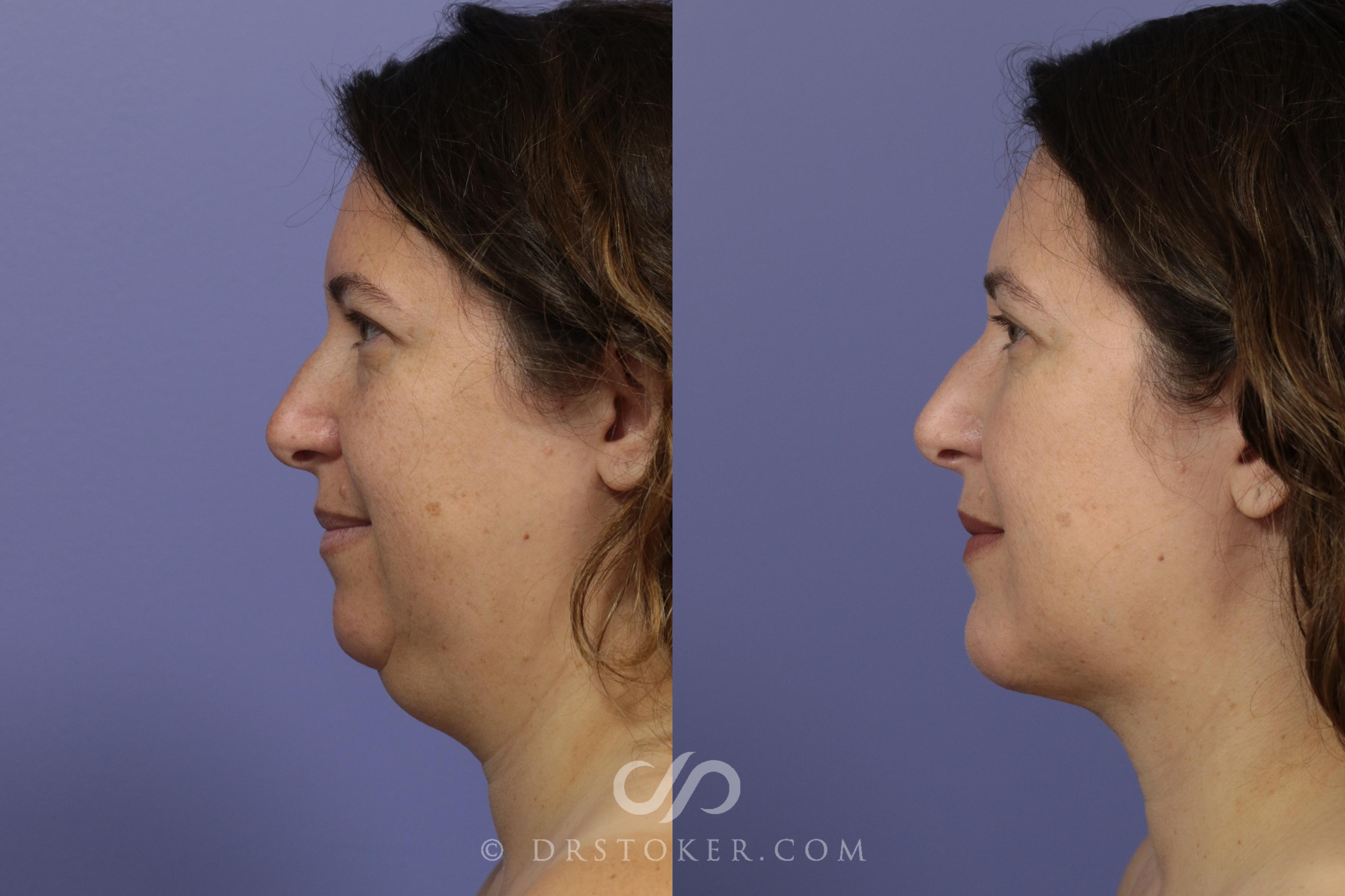 Before & After Cheek/Chin Contouring Case 1470 View #2 View in Los Angeles, CA