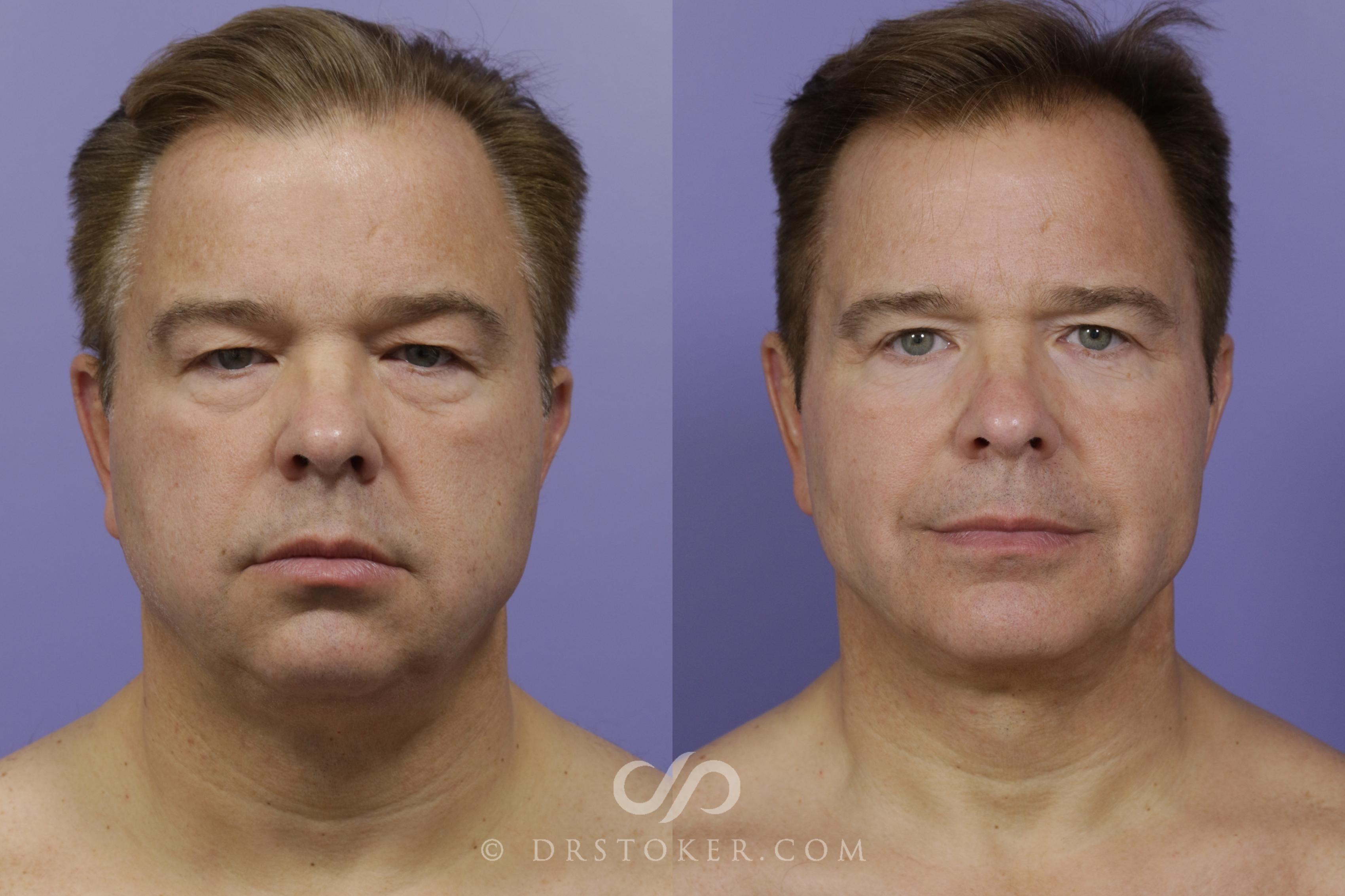 Before & After Chin Augmentation Case 1471 View #1 View in Los Angeles, CA