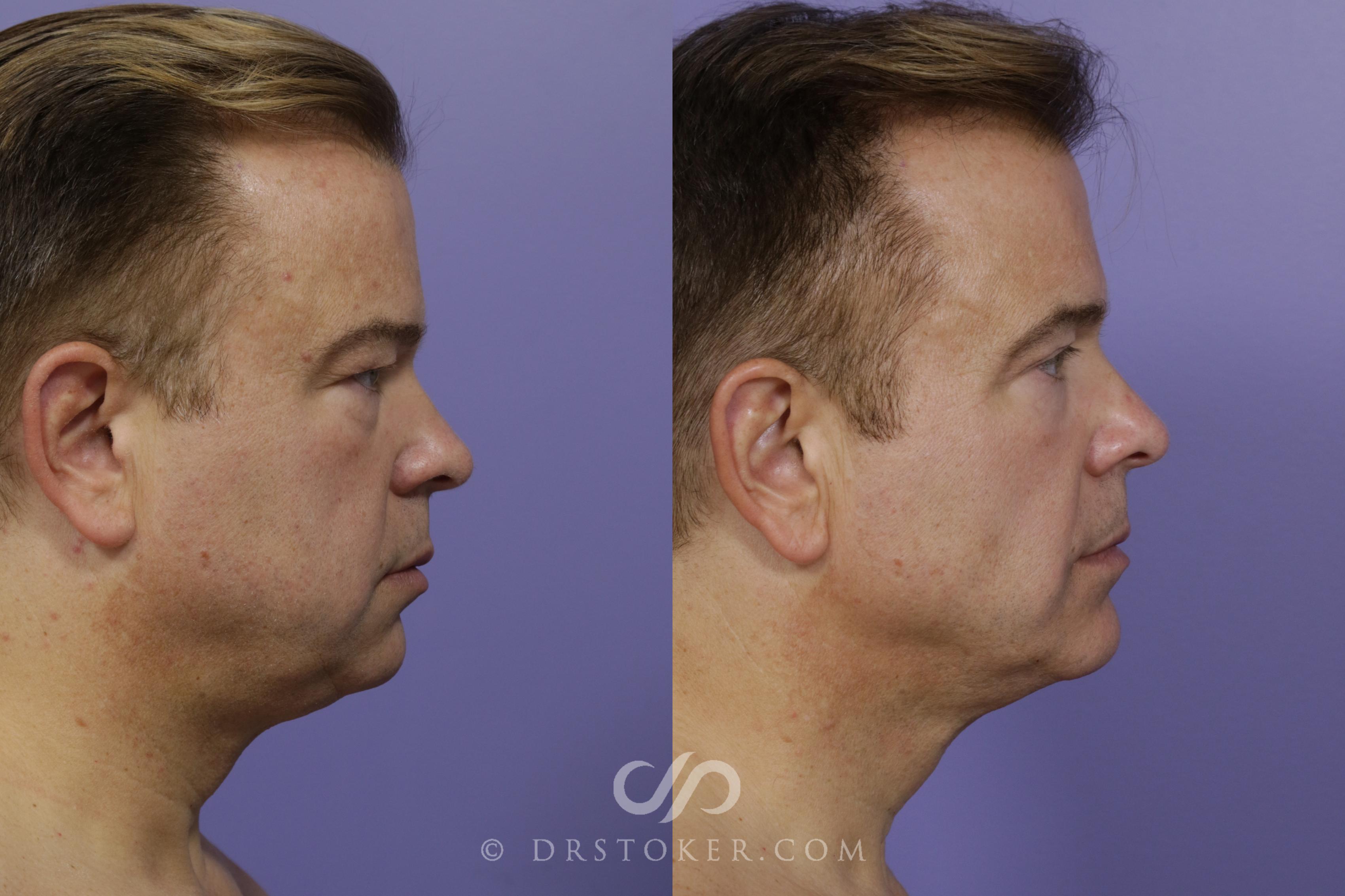 Before & After Buccal Fat Reduction Case 1471 View #3 View in Los Angeles, CA