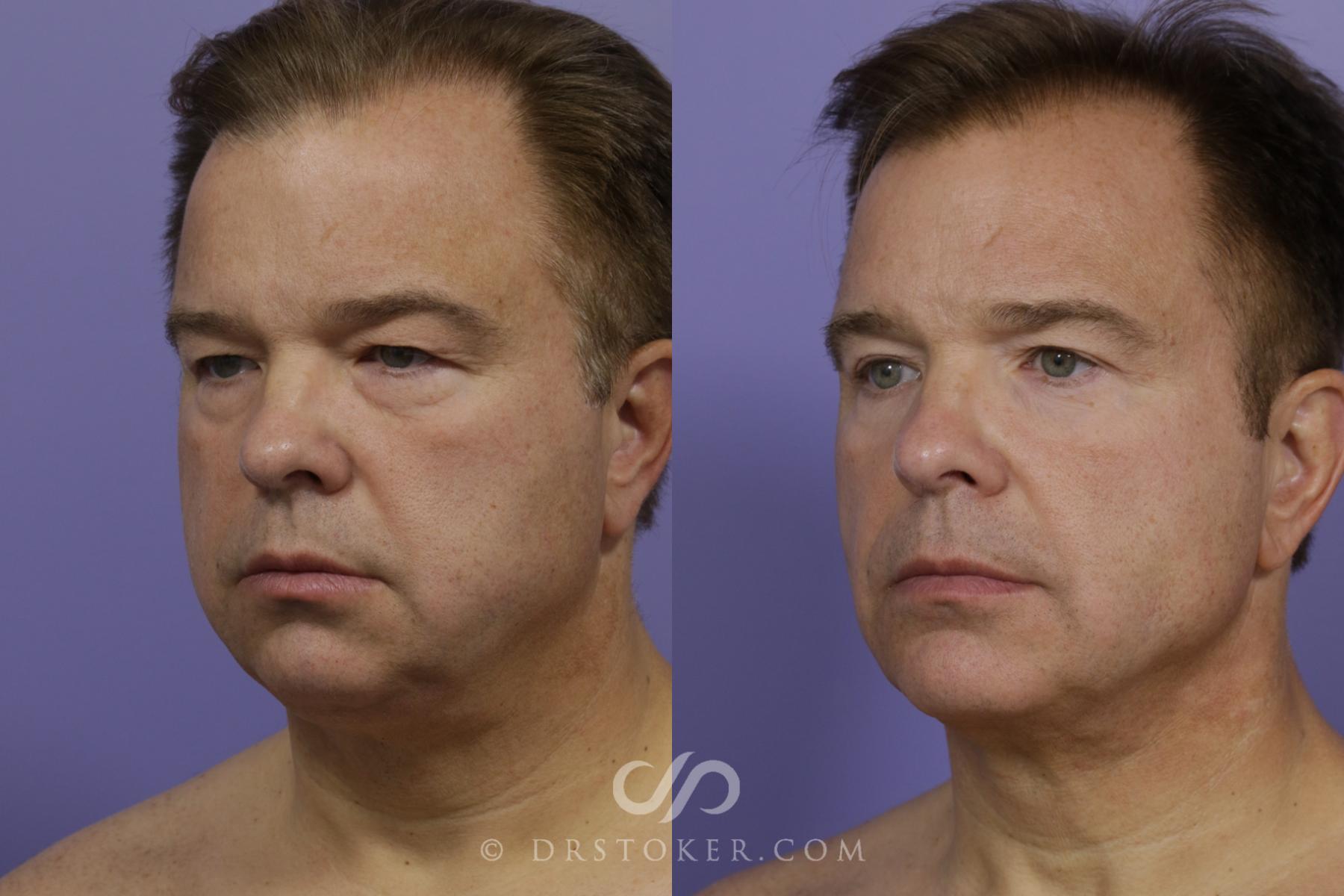 Before & After Cheek/Chin Contouring Case 1471 View #4 View in Los Angeles, CA
