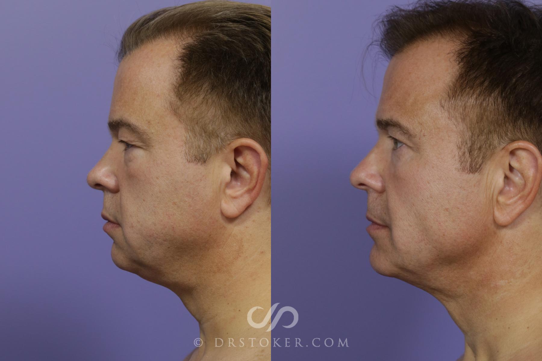 Before & After Buccal Fat Reduction Case 1471 View #5 View in Los Angeles, CA