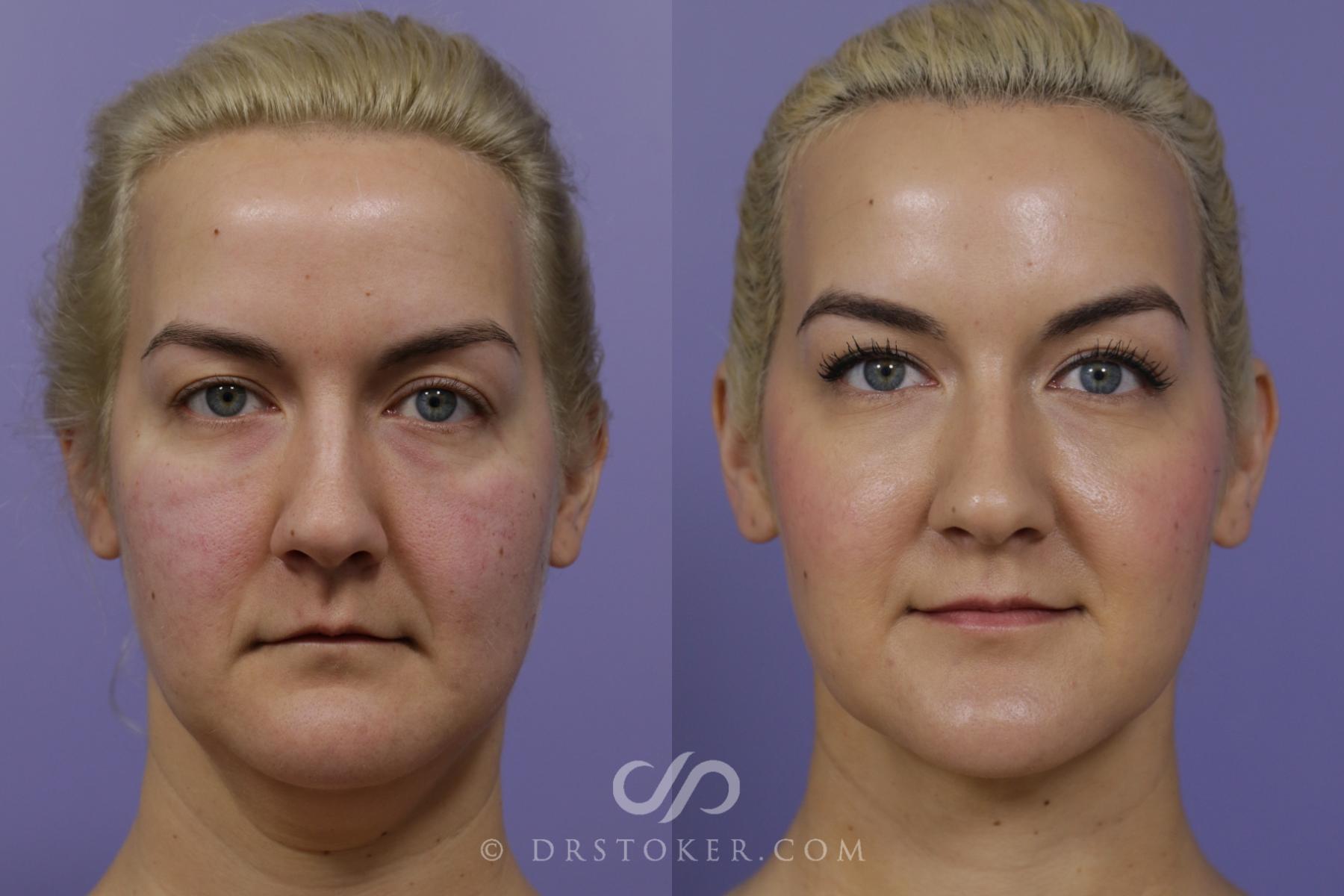 Before & After Cheek/Chin Contouring Case 1560 View #1 View in Los Angeles, CA