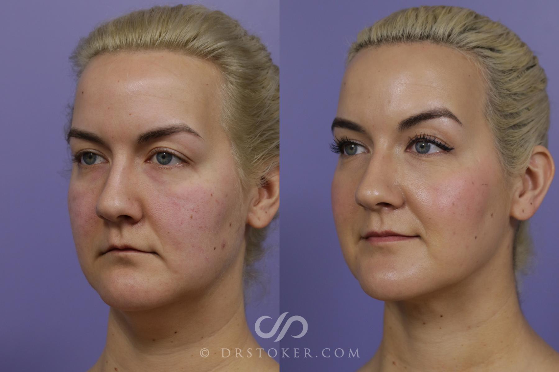 Before & After Cheek/Chin Contouring Case 1560 View #2 View in Los Angeles, CA
