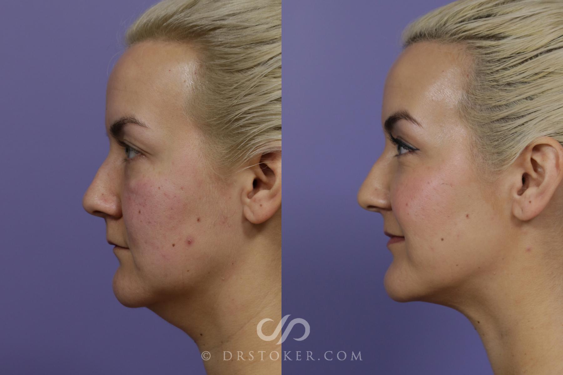 Before & After Cheek/Chin Contouring Case 1560 View #3 View in Los Angeles, CA