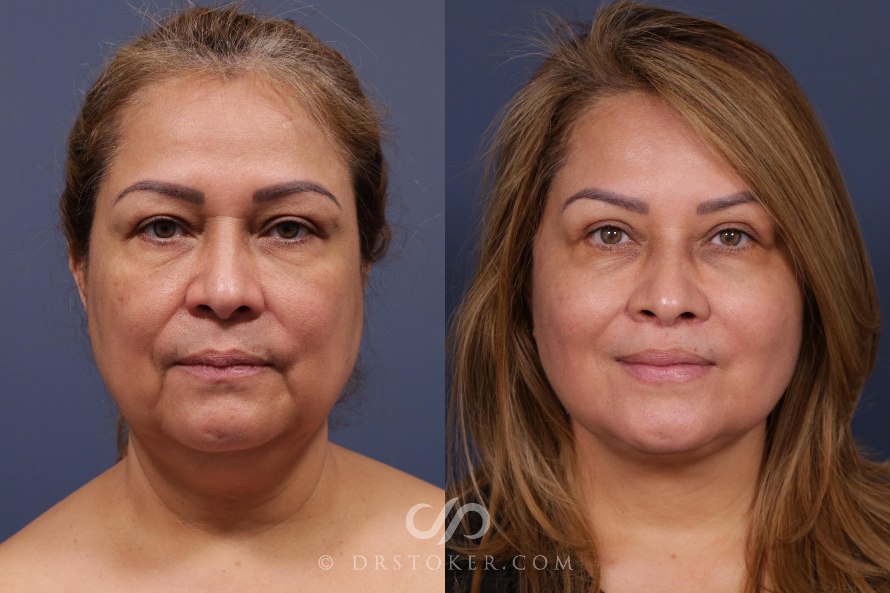 Before & After Buccal Fat Reduction Case 2031 Front View in Los Angeles, CA