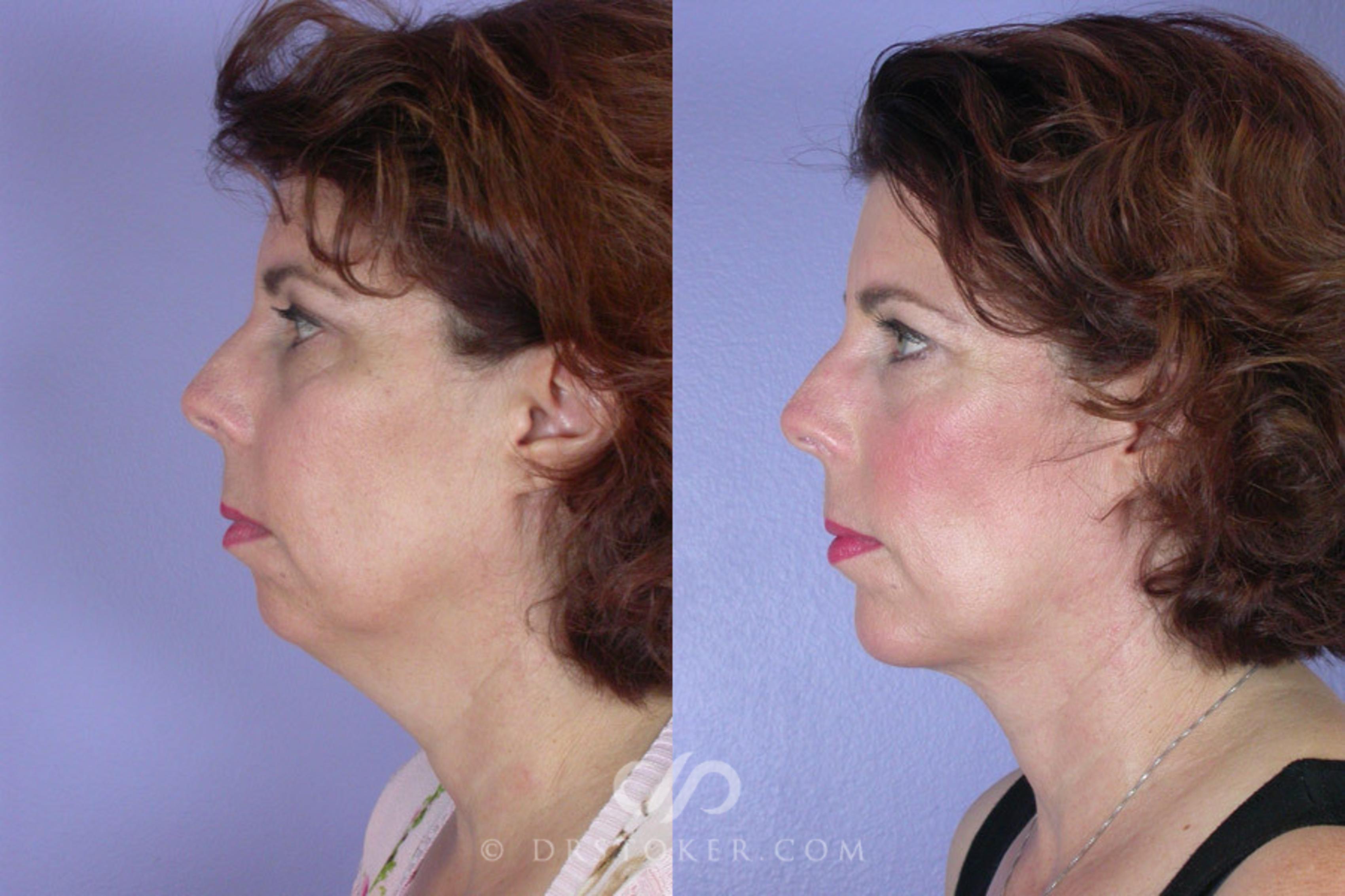 Before & After Liposuction - Neck Case 258 View #1 View in Los Angeles, CA