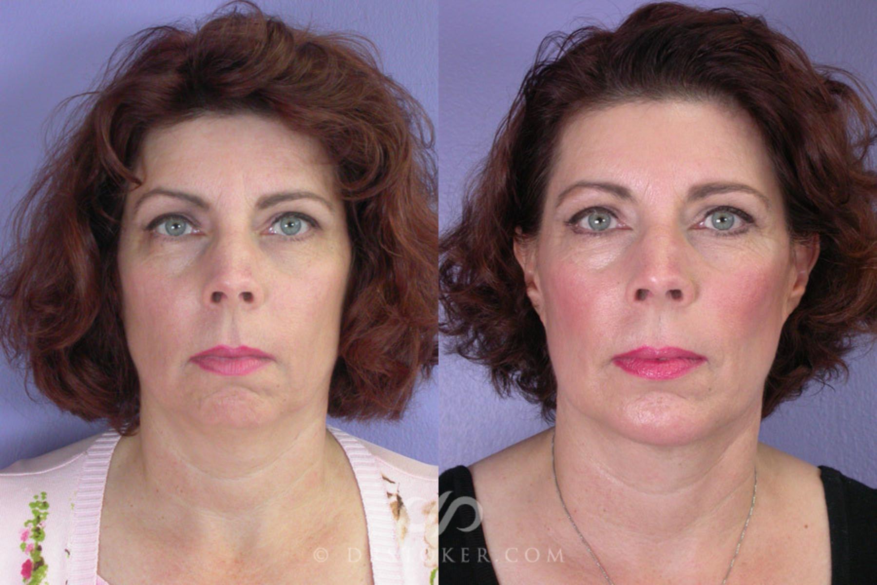 Before & After Liposuction - Neck Case 258 View #2 View in Los Angeles, CA