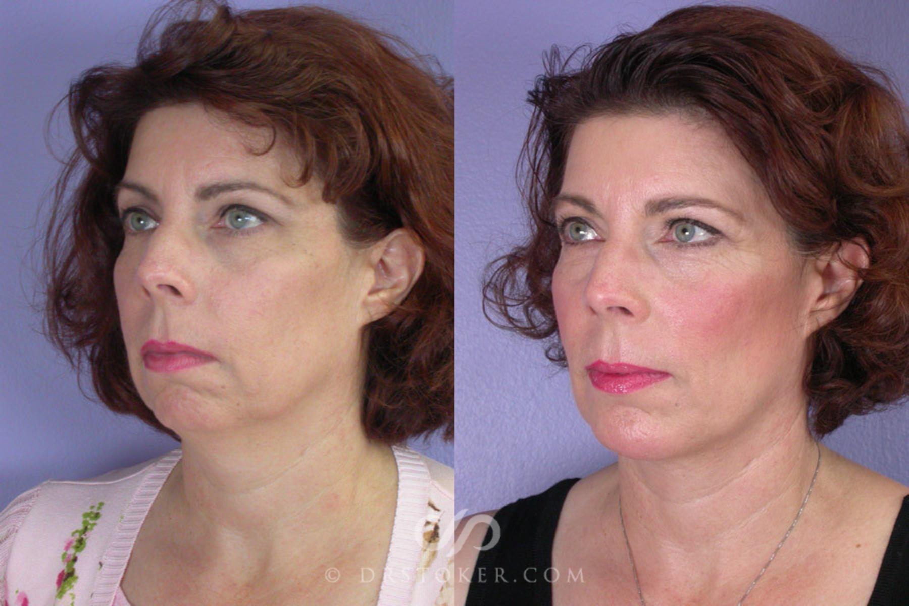 Before & After Cheek/Chin Contouring Case 258 View #3 View in Los Angeles, CA