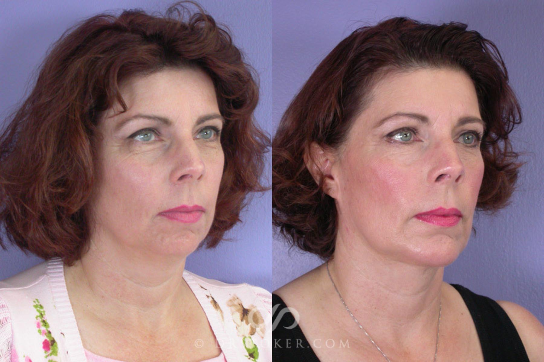 Before & After Liposuction - Neck Case 258 View #4 View in Los Angeles, CA