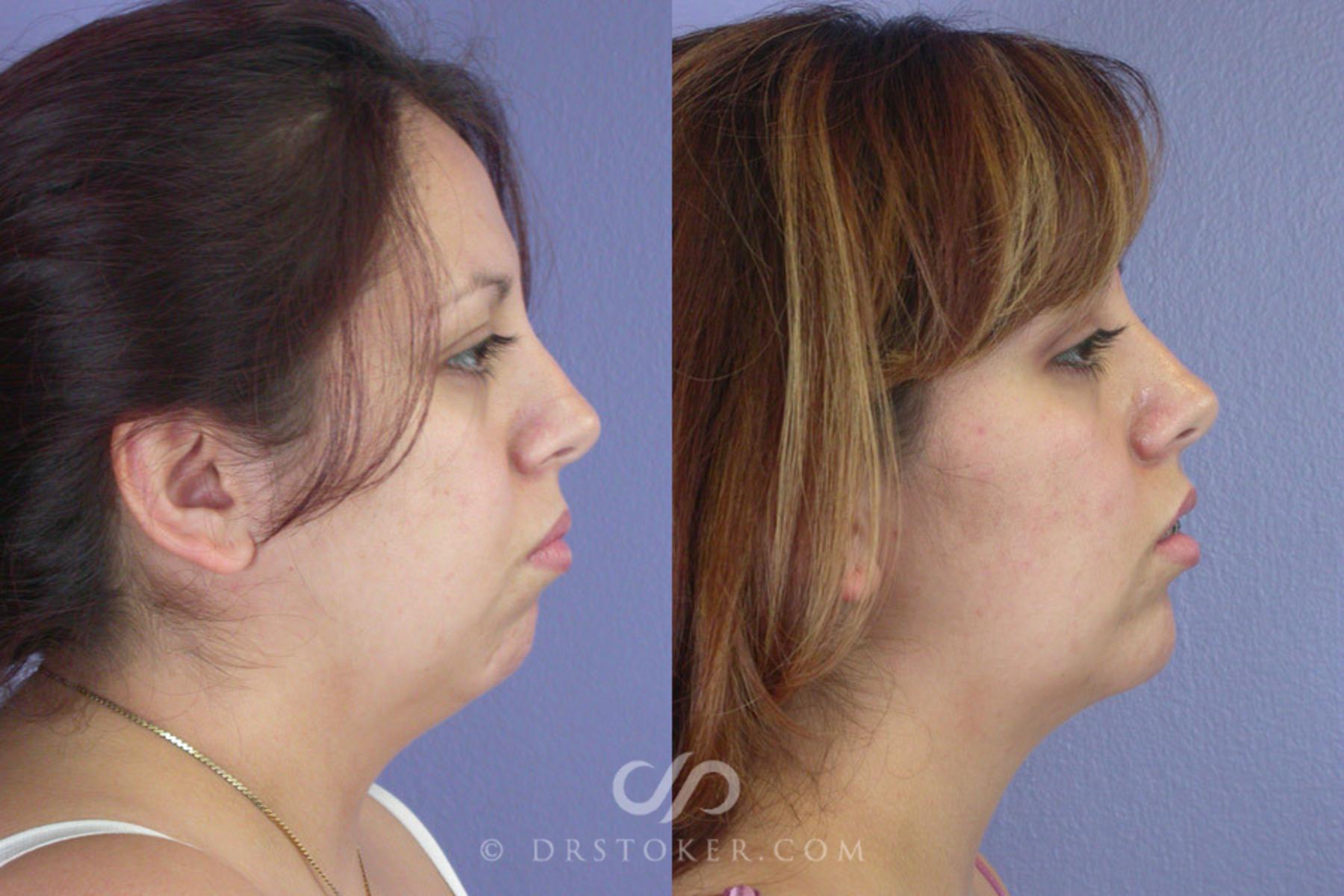 Before & After Cheek/Chin Contouring Case 259 View #2 View in Los Angeles, CA