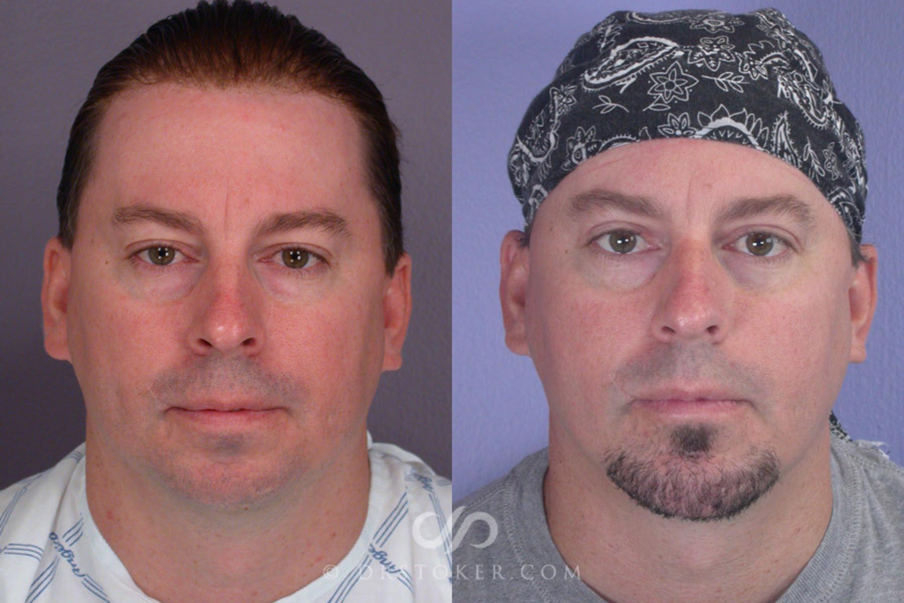Before & After Liposuction - Neck Case 260 View #2 View in Los Angeles, CA