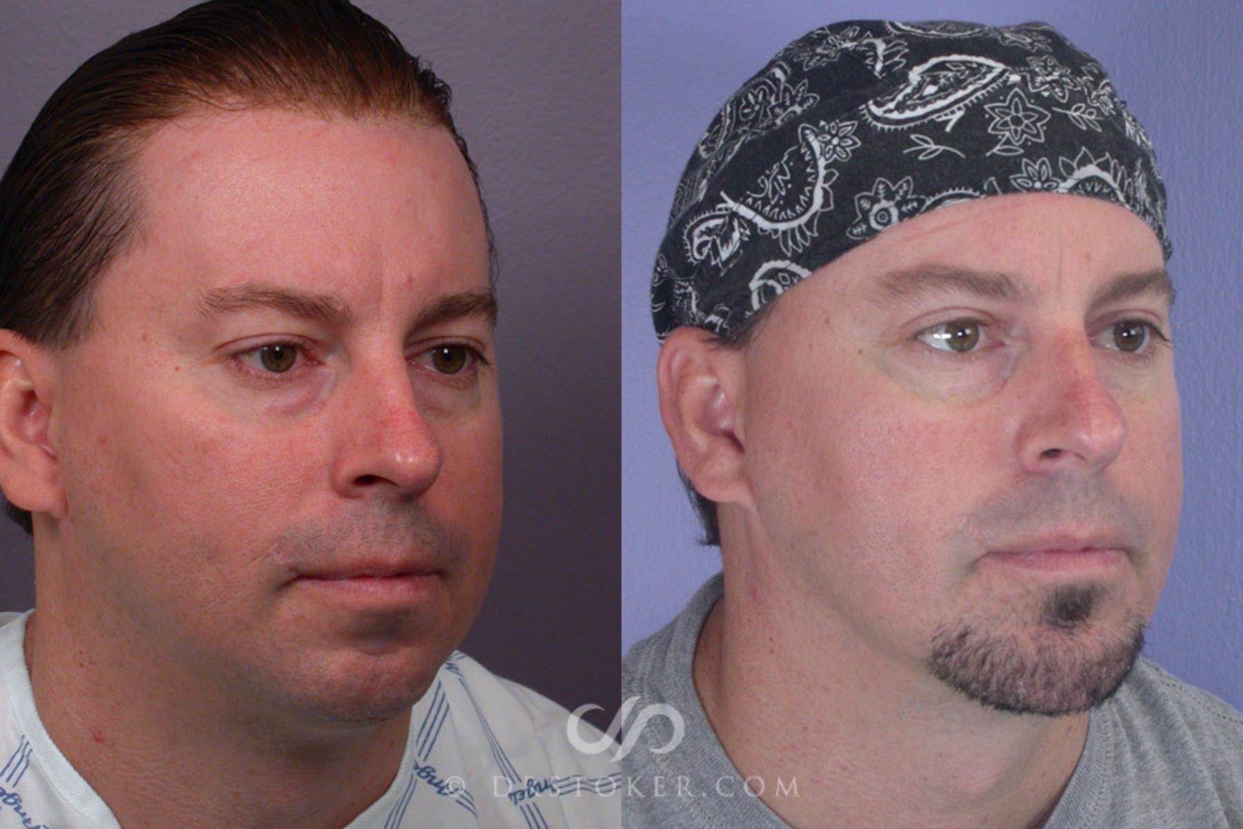 Before & After Cheek/Chin Contouring Case 260 View #3 View in Los Angeles, CA