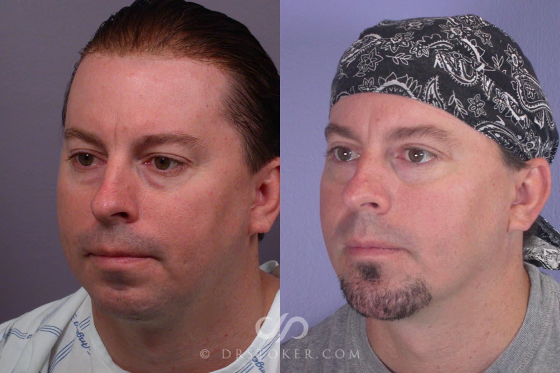 Before & After Chin Augmentation Case 260 View #4 View in Los Angeles, CA