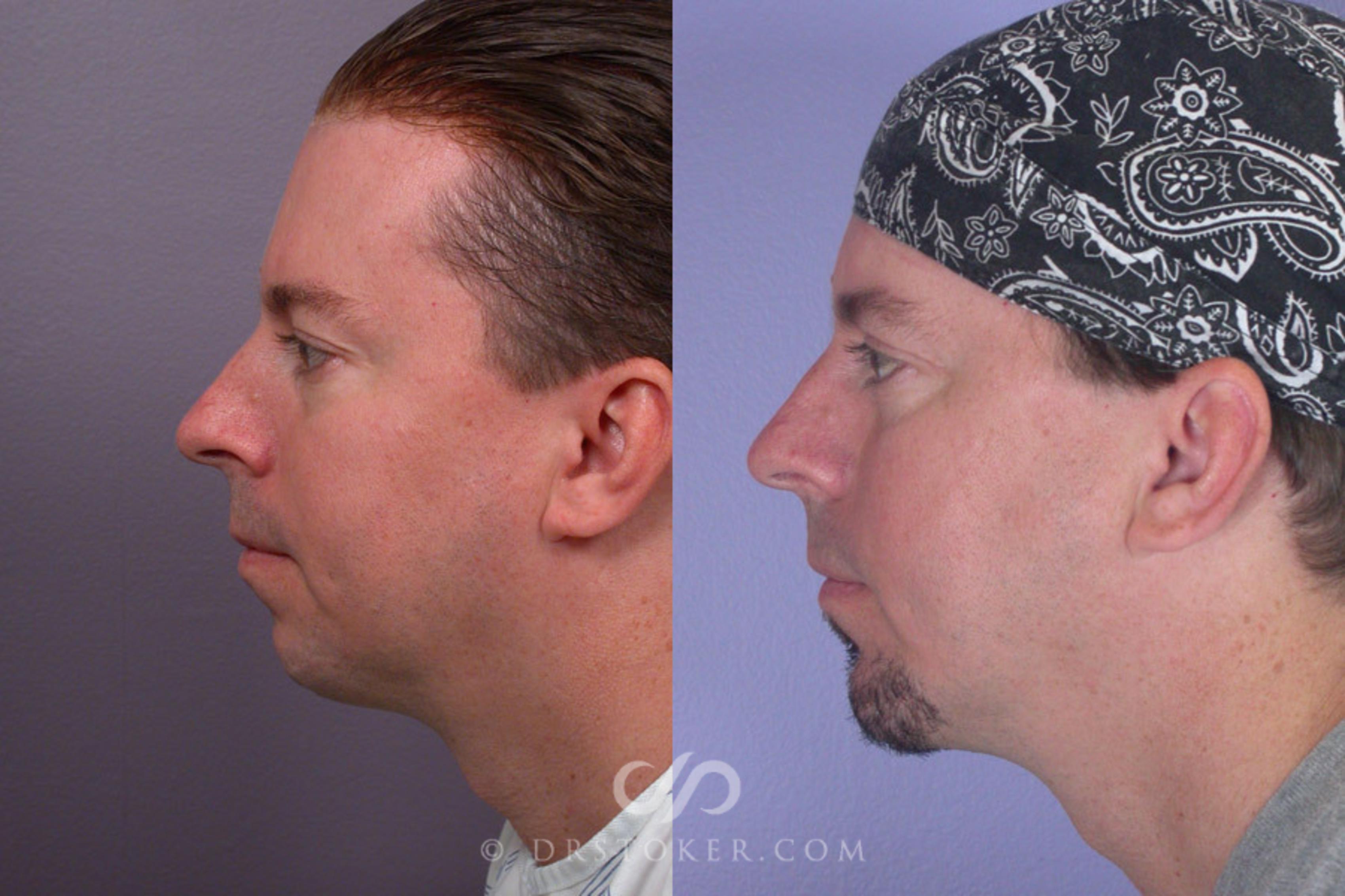 Before & After Cheek/Chin Contouring Case 260 View #5 View in Los Angeles, CA