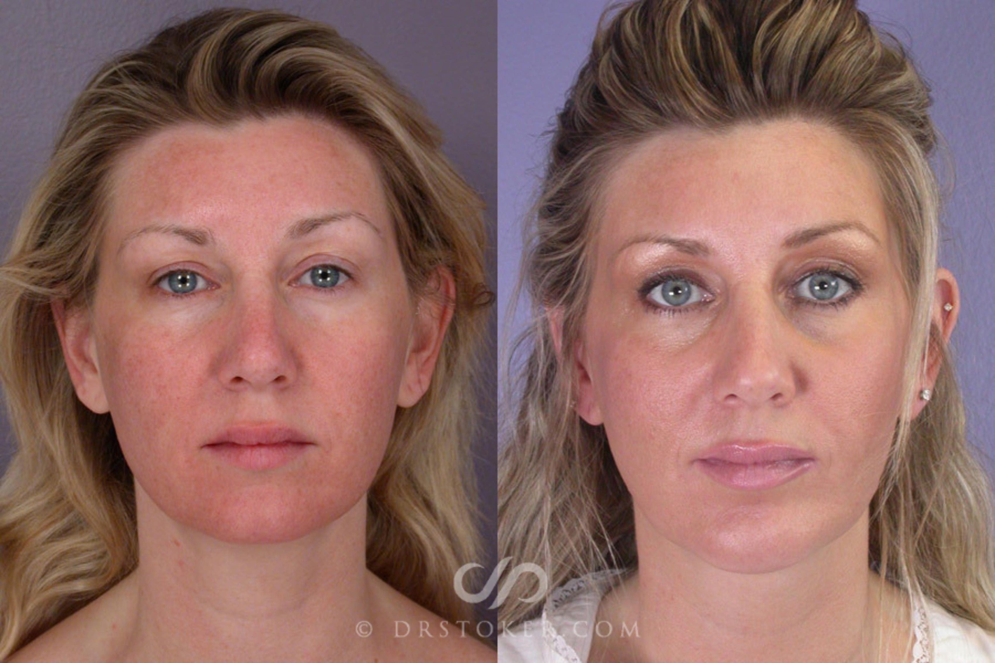 Before & After Cheek/Chin Contouring Case 261 View #1 View in Los Angeles, CA