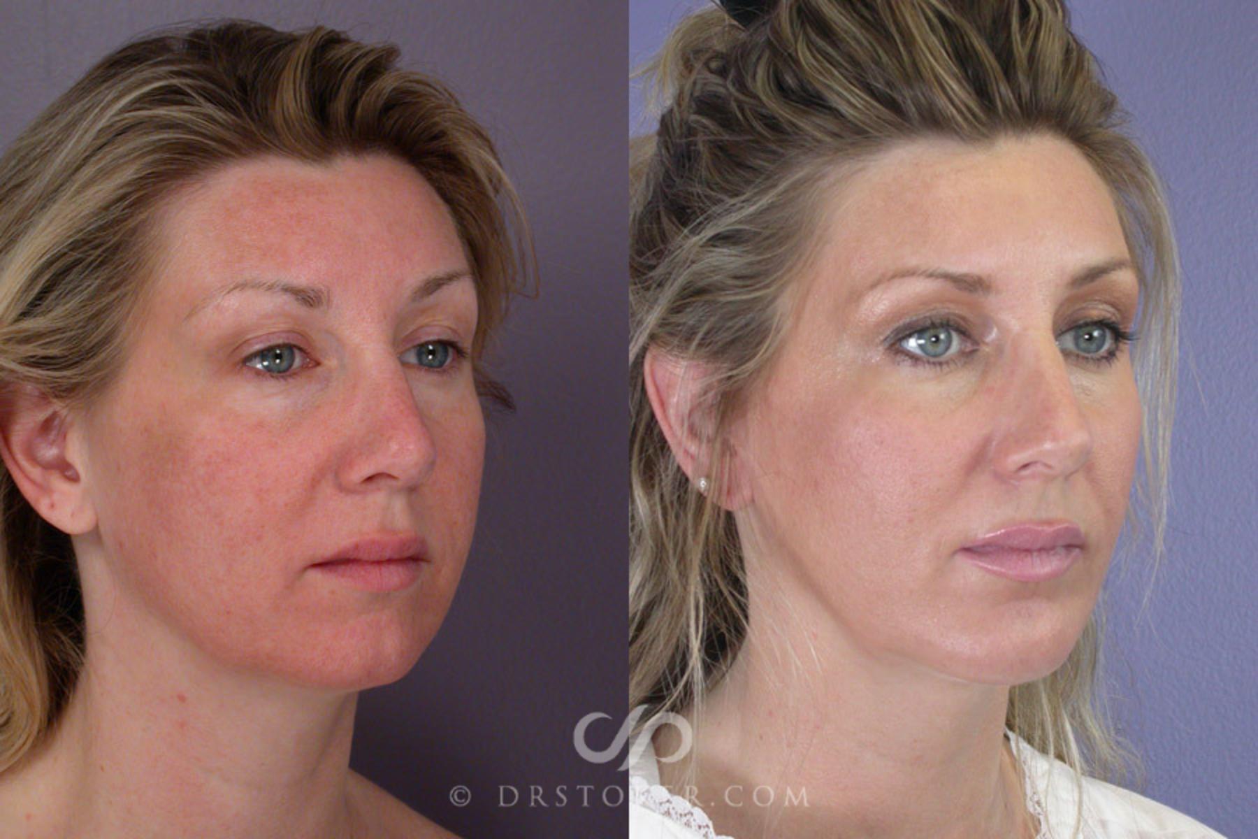 Before & After Cheek/Chin Contouring Case 261 View #2 View in Los Angeles, CA