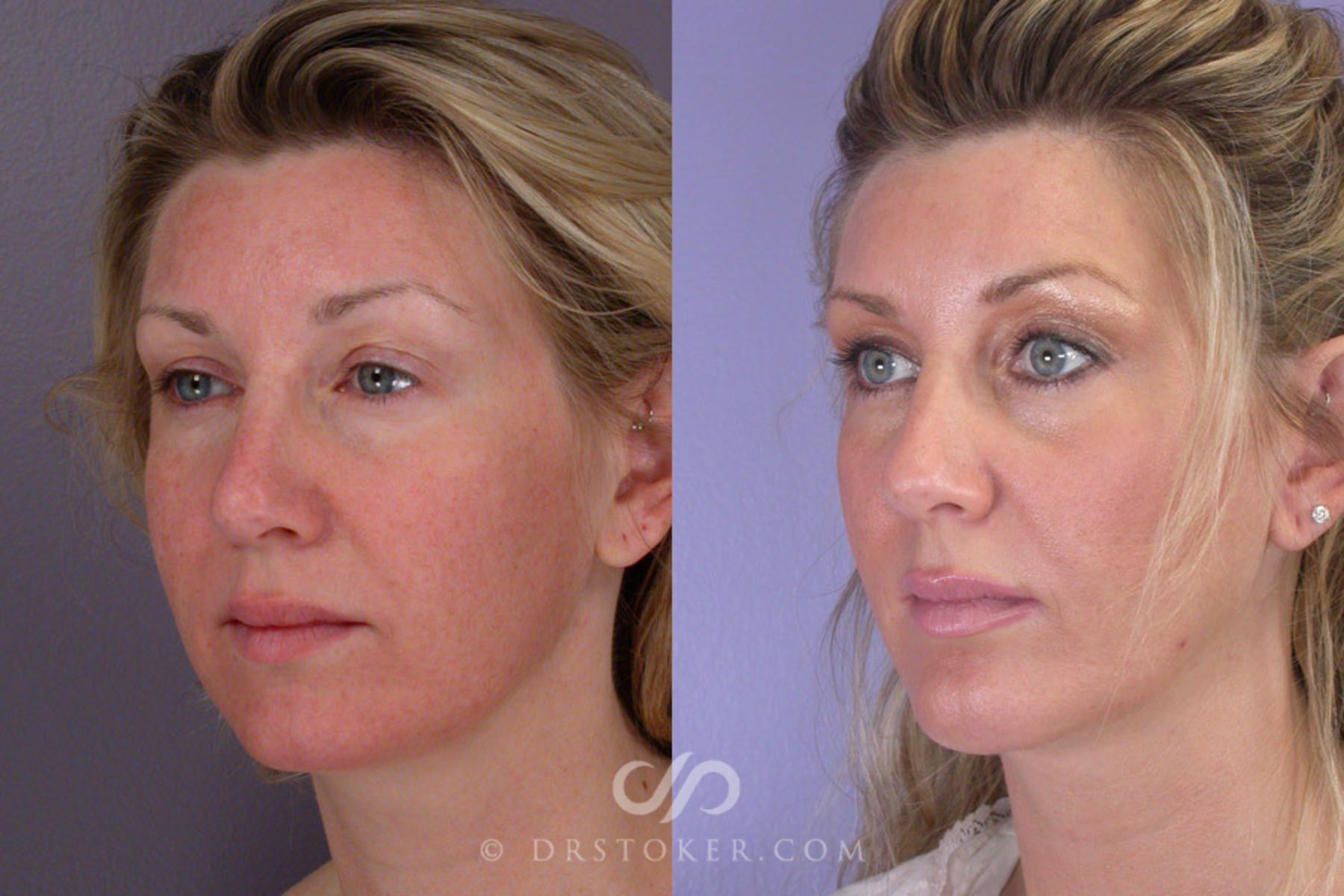 Before & After Cheek/Chin Contouring Case 261 View #3 View in Los Angeles, CA
