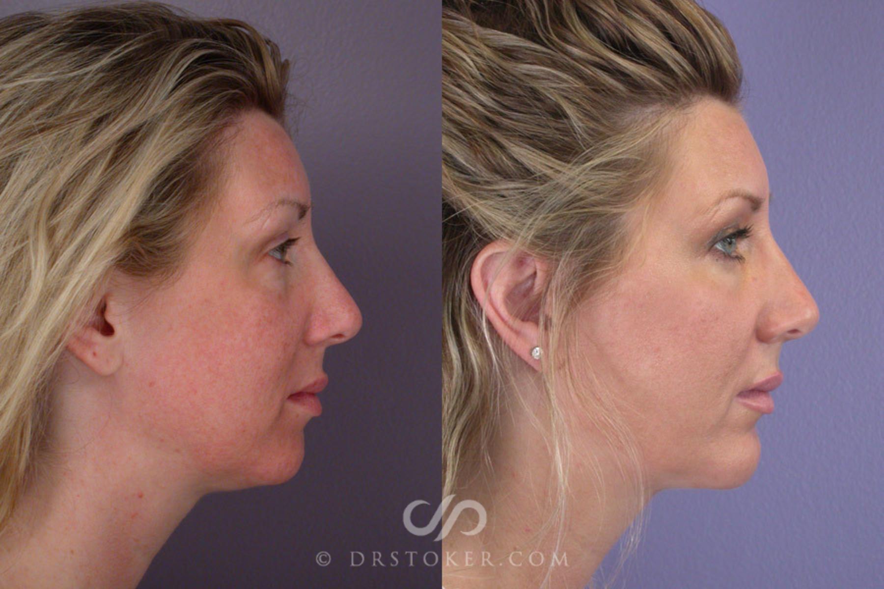 Before & After Cheek/Chin Contouring Case 261 View #4 View in Los Angeles, CA