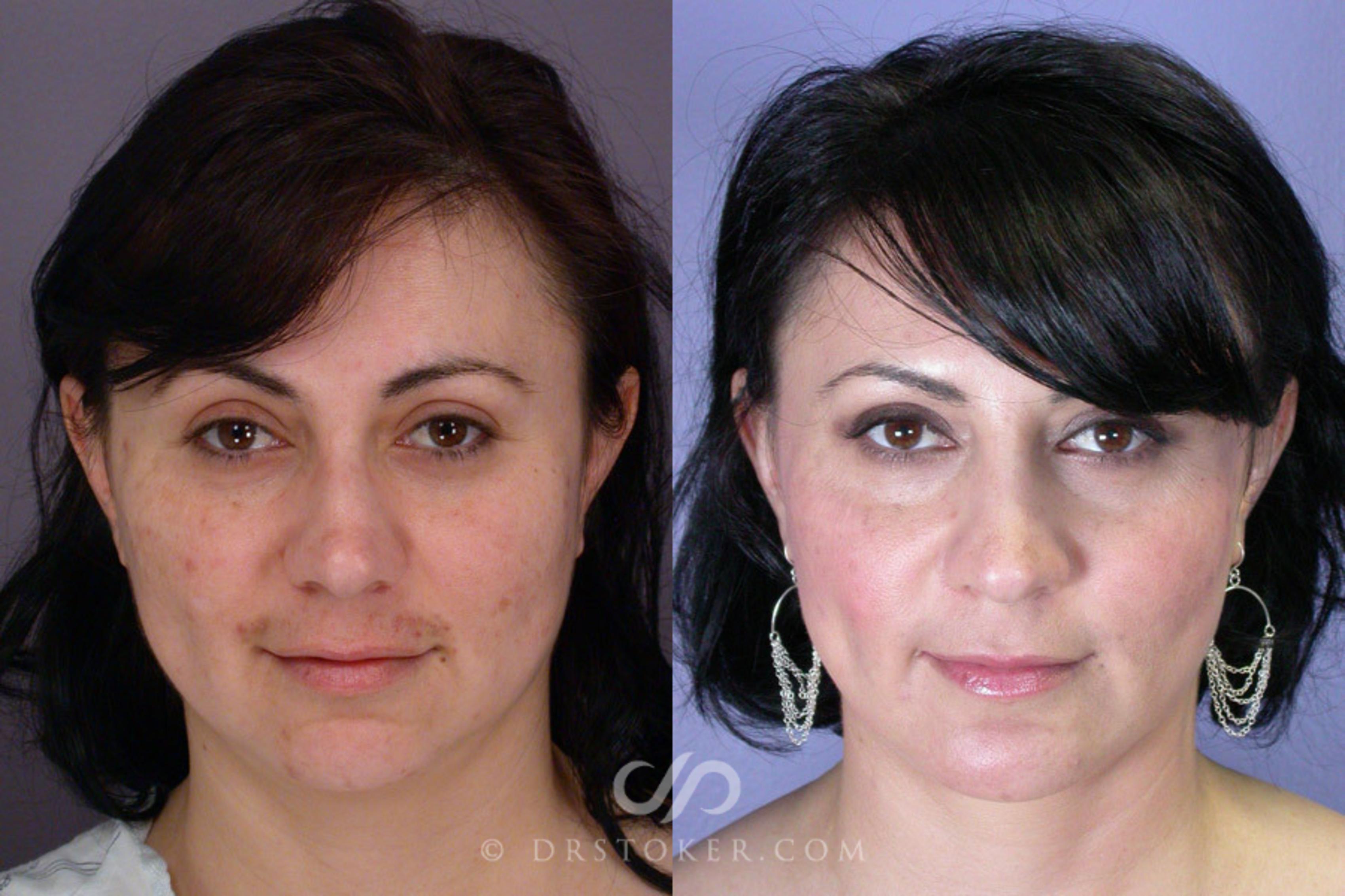Before & After Cheek/Chin Contouring Case 262 View #1 View in Los Angeles, CA