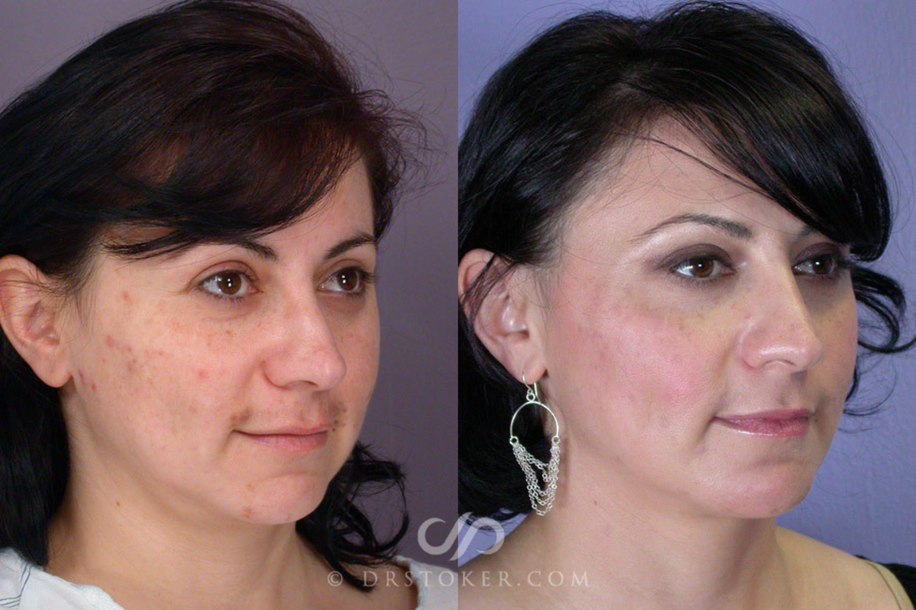 Before & After Cheek/Chin Contouring Case 262 View #2 View in Los Angeles, CA