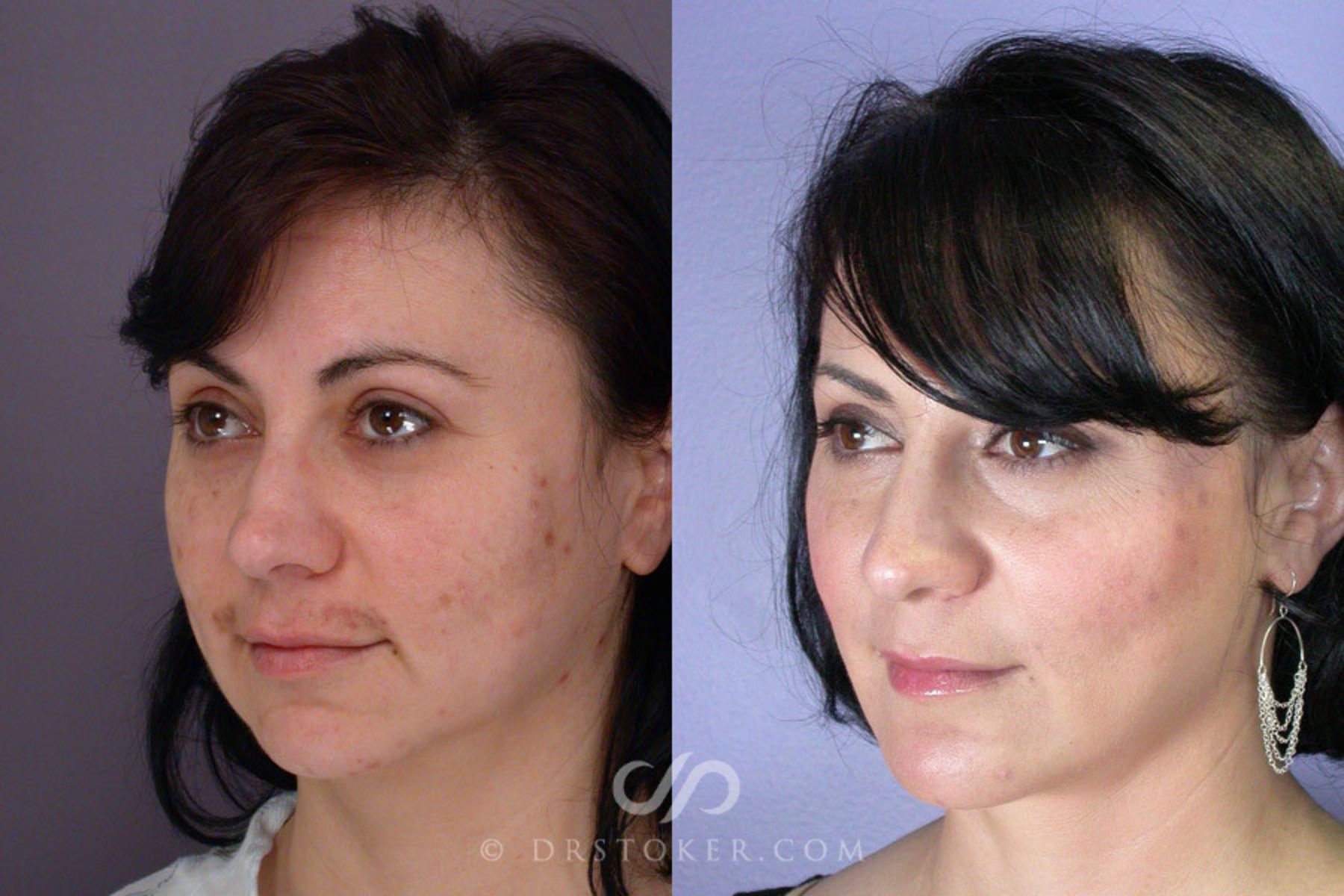 Before & After Cheek/Chin Contouring Case 262 View #3 View in Los Angeles, CA