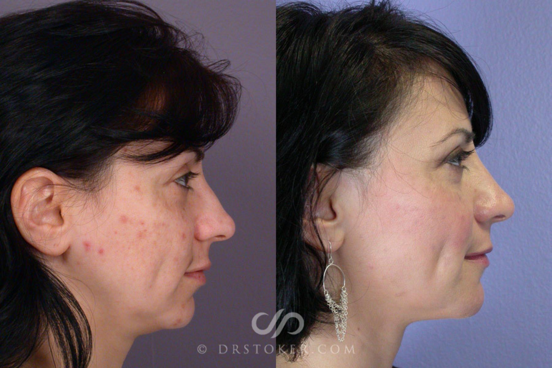 Before & After Cheek/Chin Contouring Case 262 View #4 View in Los Angeles, CA