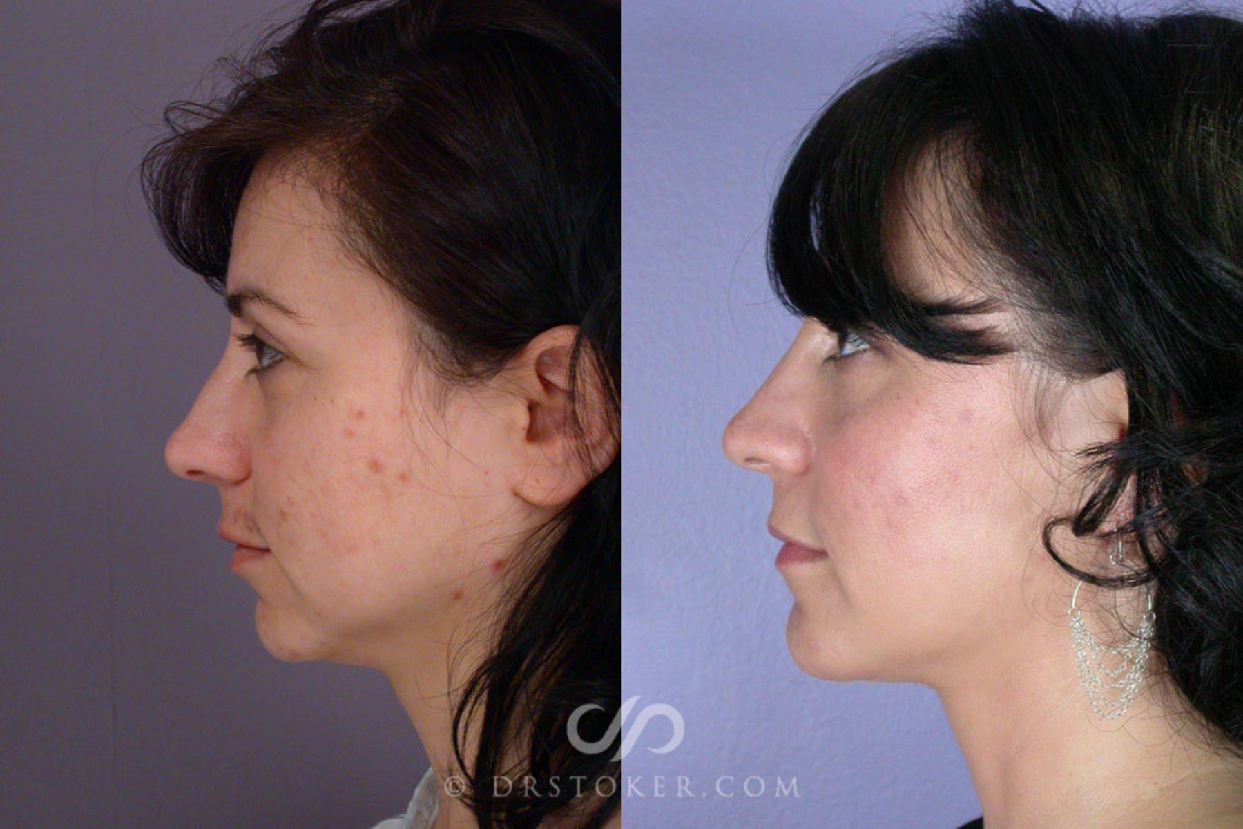 Before & After Cheek/Chin Contouring Case 262 View #5 View in Los Angeles, CA
